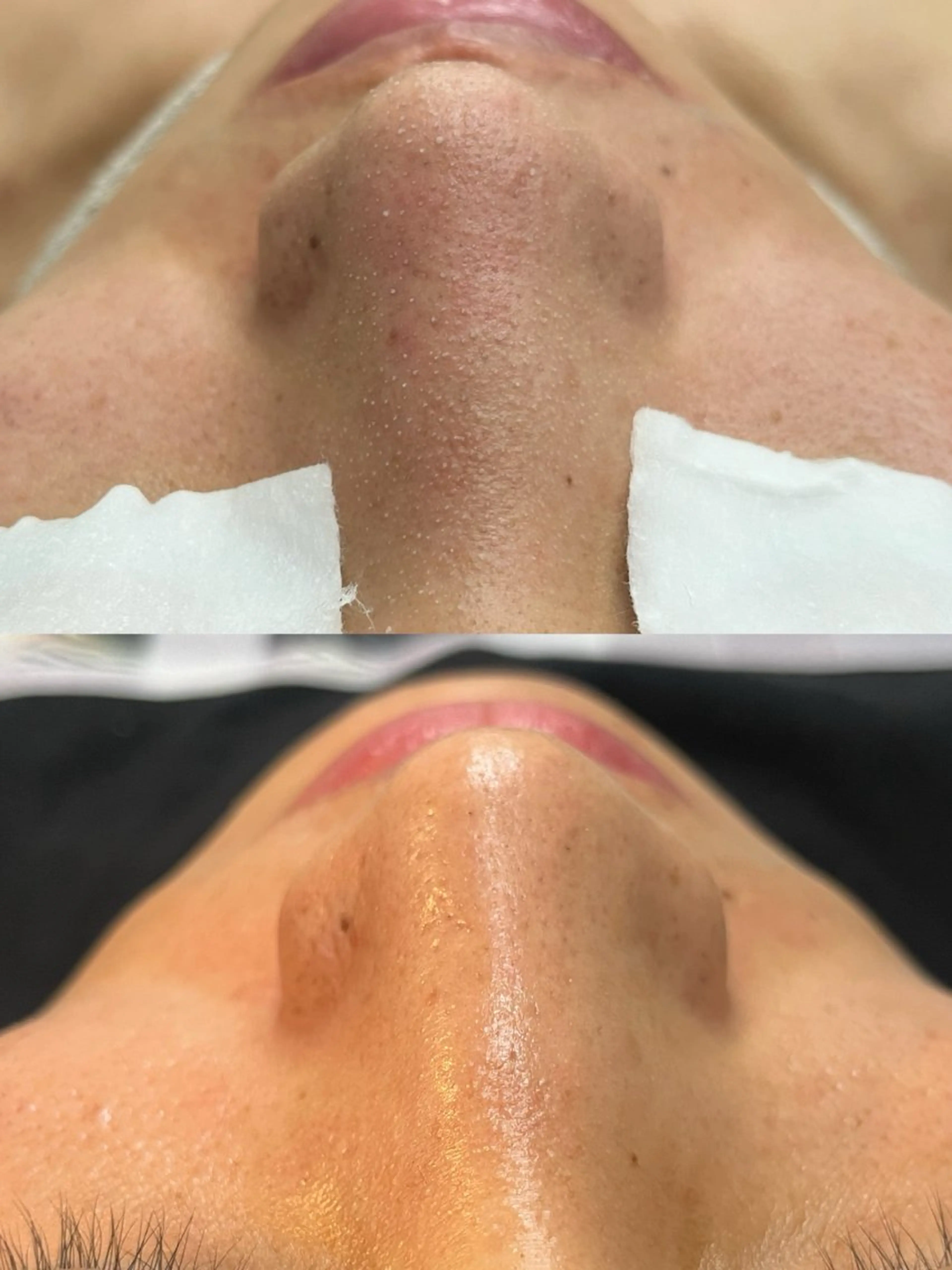 ハイドロスプラッシュ毛穴洗浄✨の写真