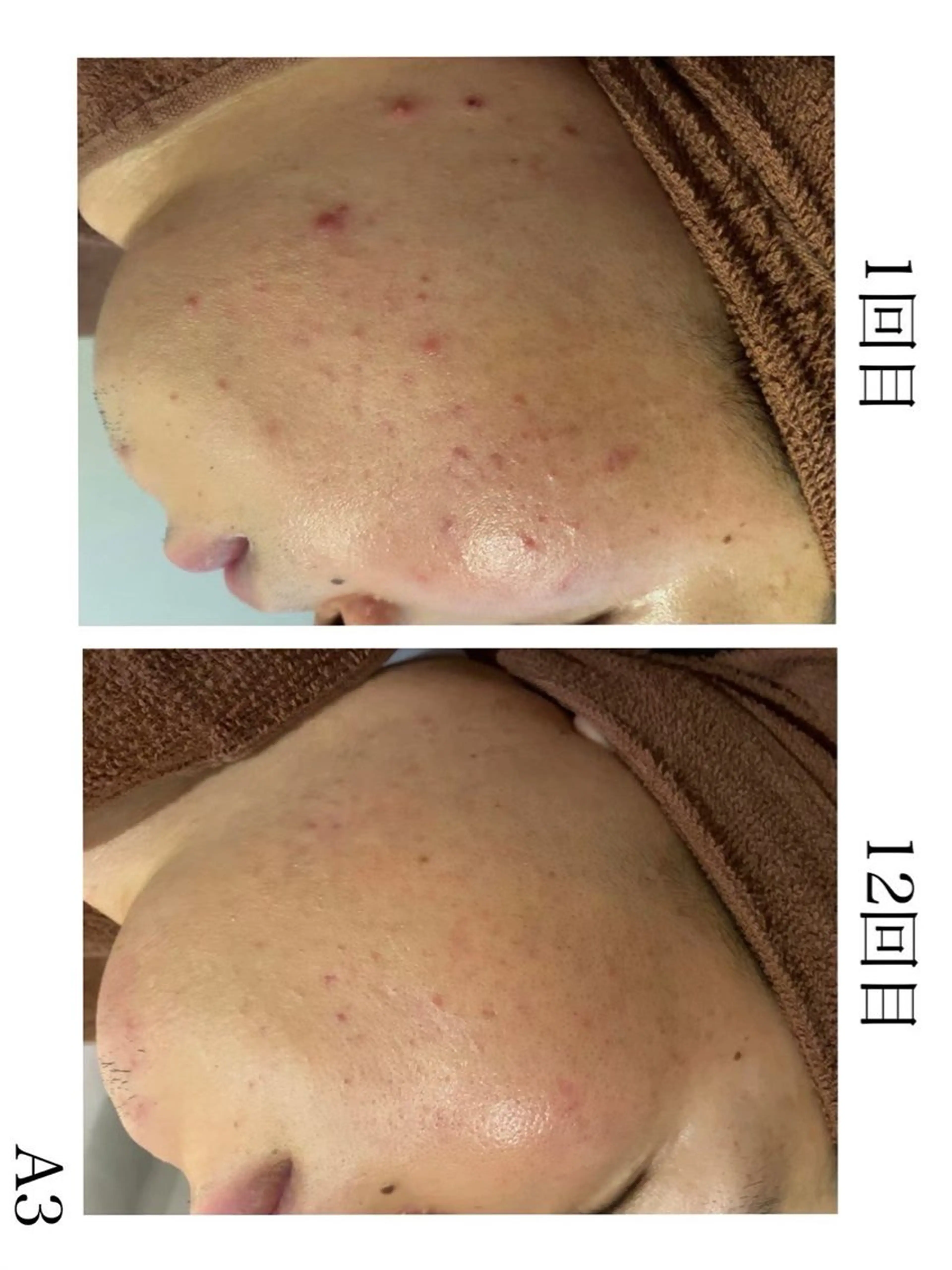 学生ニキビ改善🍀 優しい肌質改善のエステ・リラクイメージ