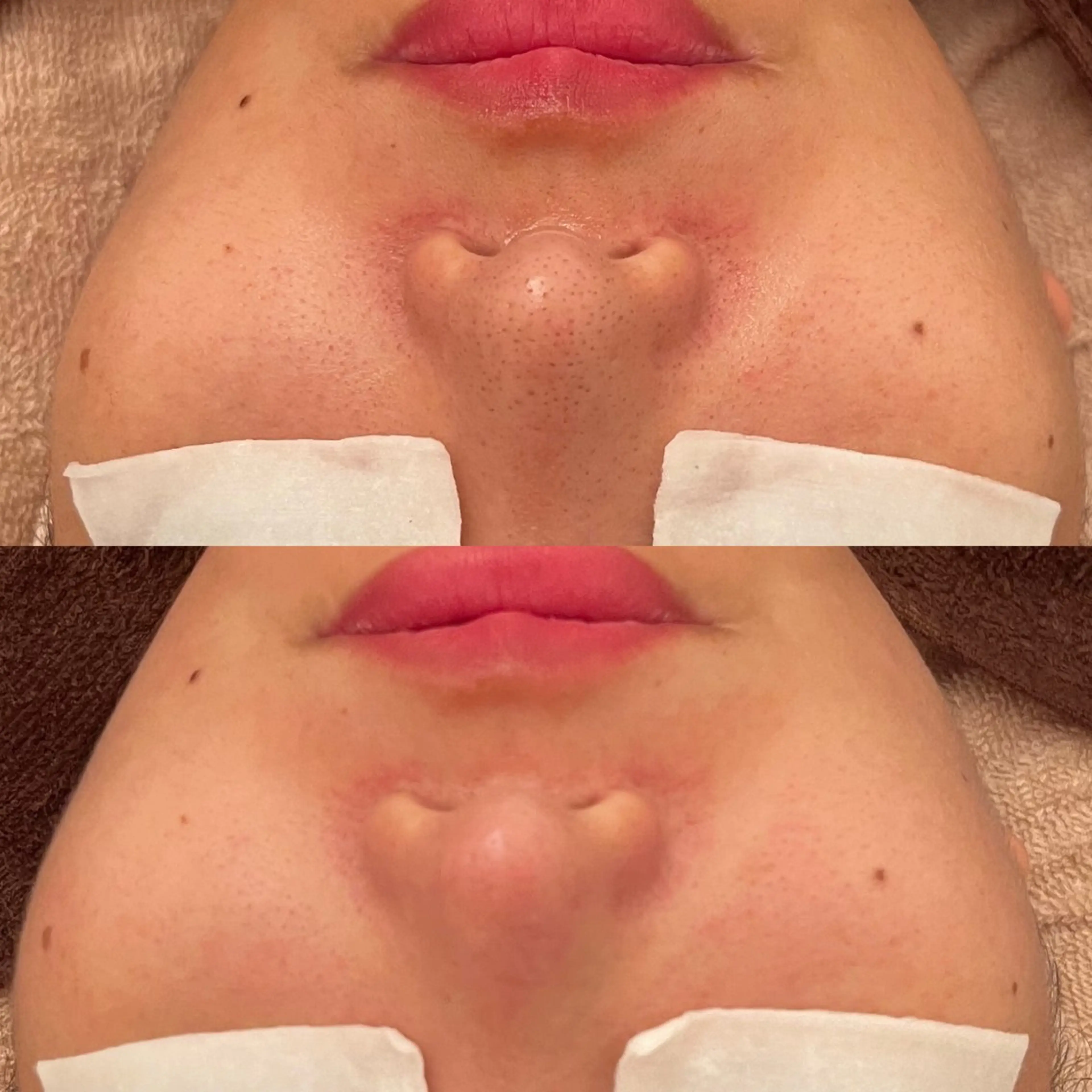 《脱いちご鼻》ハイドラ毛穴レスコース/黒ずみ/毛穴詰まり/毛穴診断付きの写真