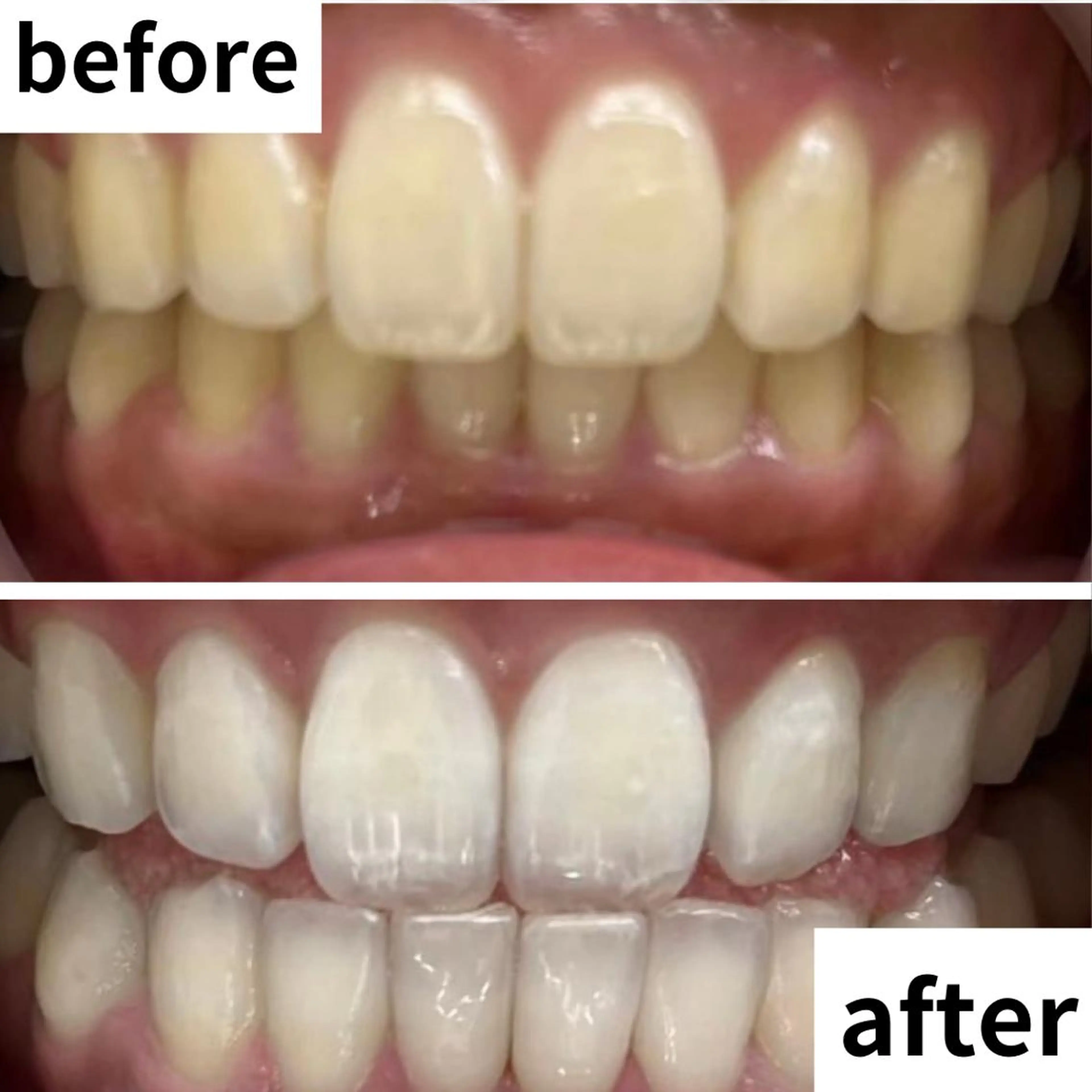 【🔥本気で白い歯にしたい方へ🔥】5分照射×6回❣照射パワー2倍のハイパワー照射機で即効性◎時短ホワイトニングの写真