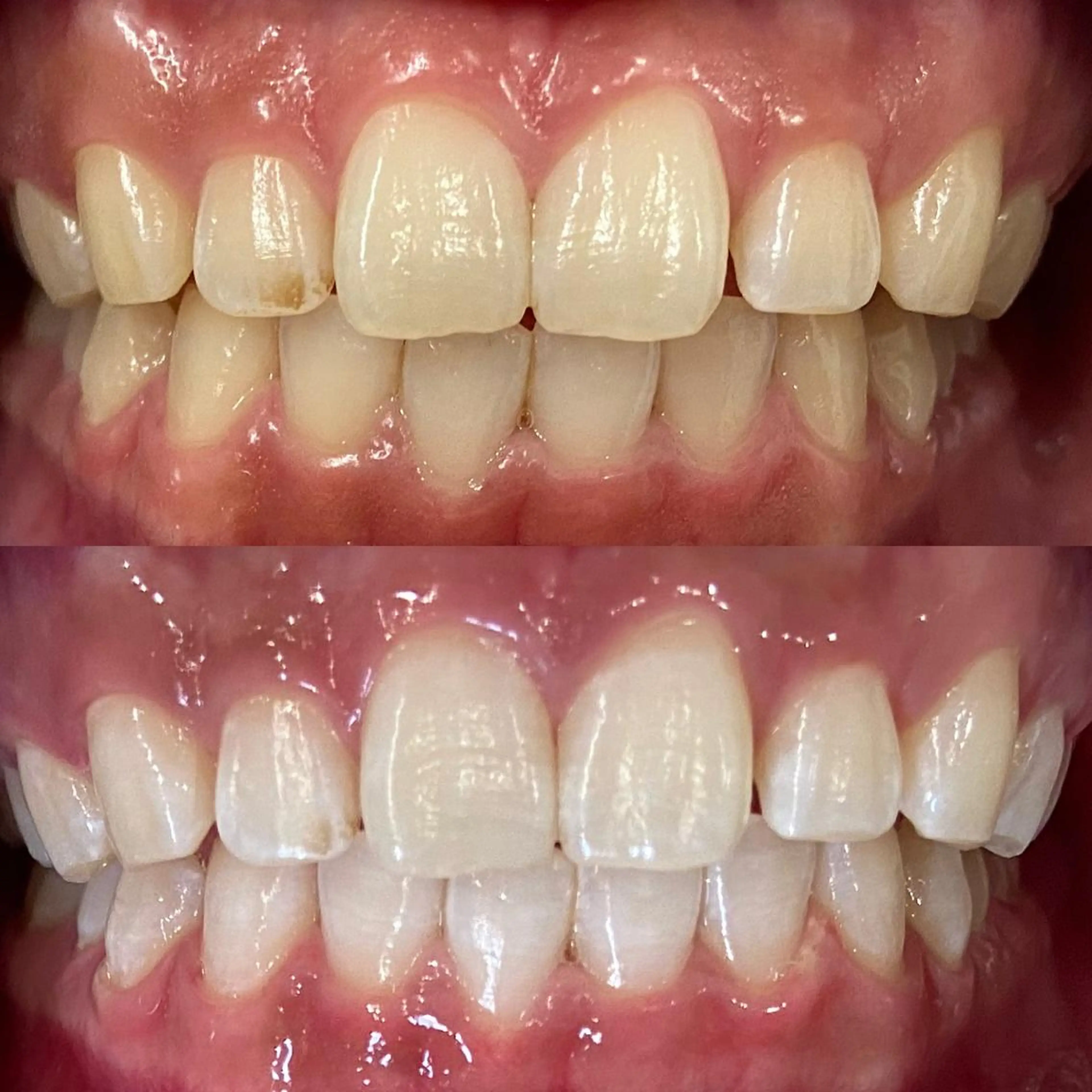 🦷minimo限定価格🦷12分×3照射 10000→3,500円❣️の写真