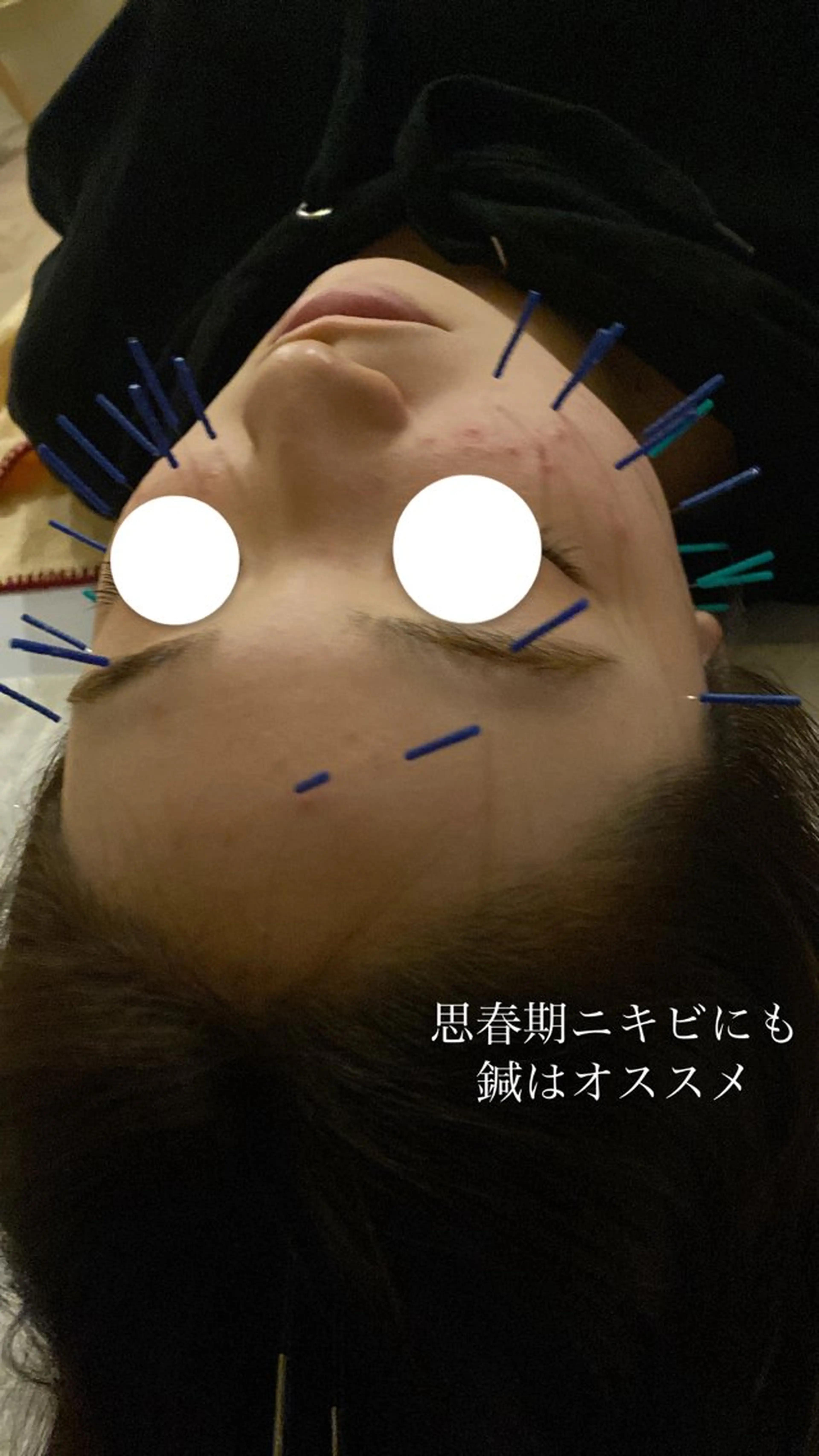 美容鍼/ヘッドスパ/ 💎さかもとのエステ・リラクイメージ