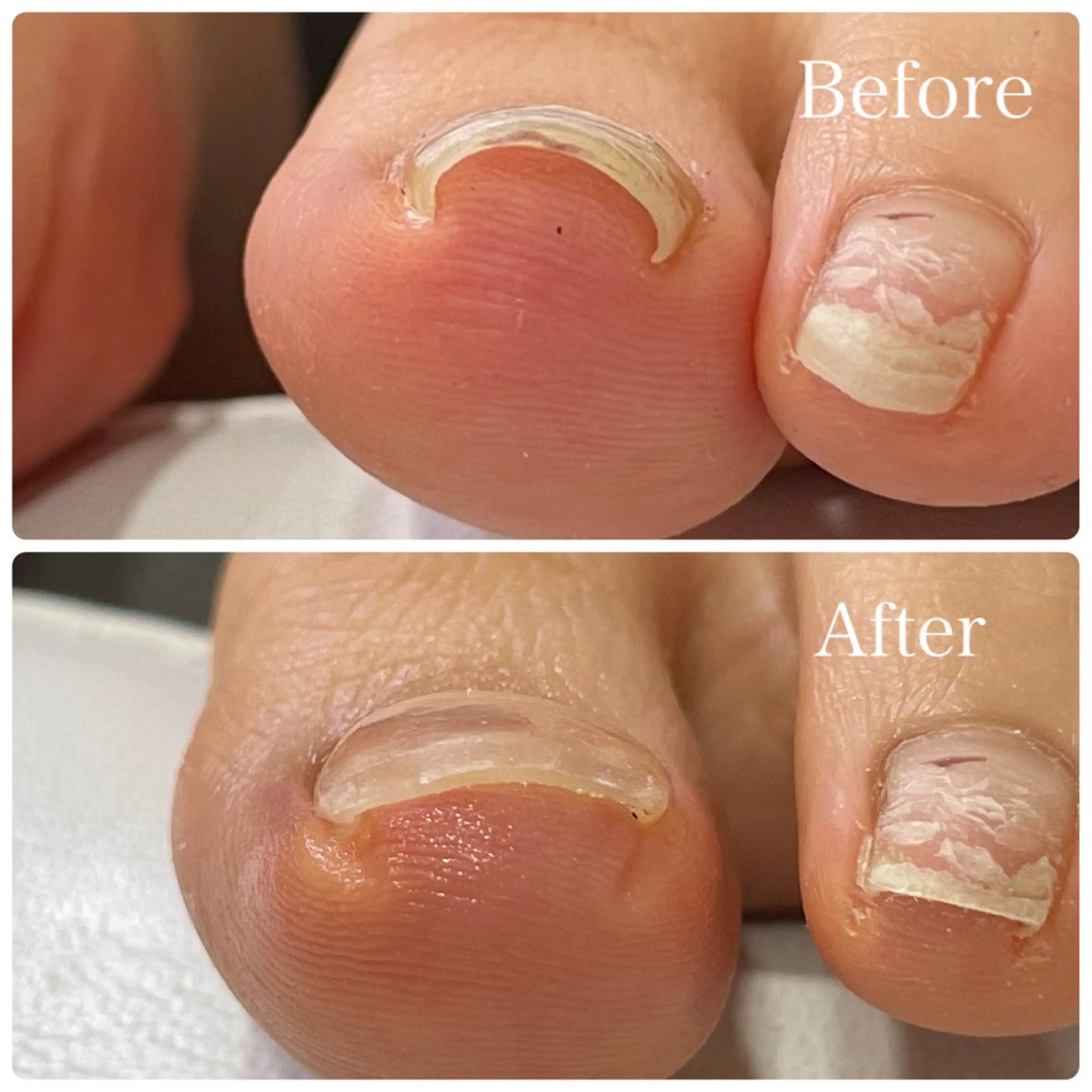 《モデル募集》巻き爪補正❤️‍🔥詳細情報も必ずご覧ください！の写真