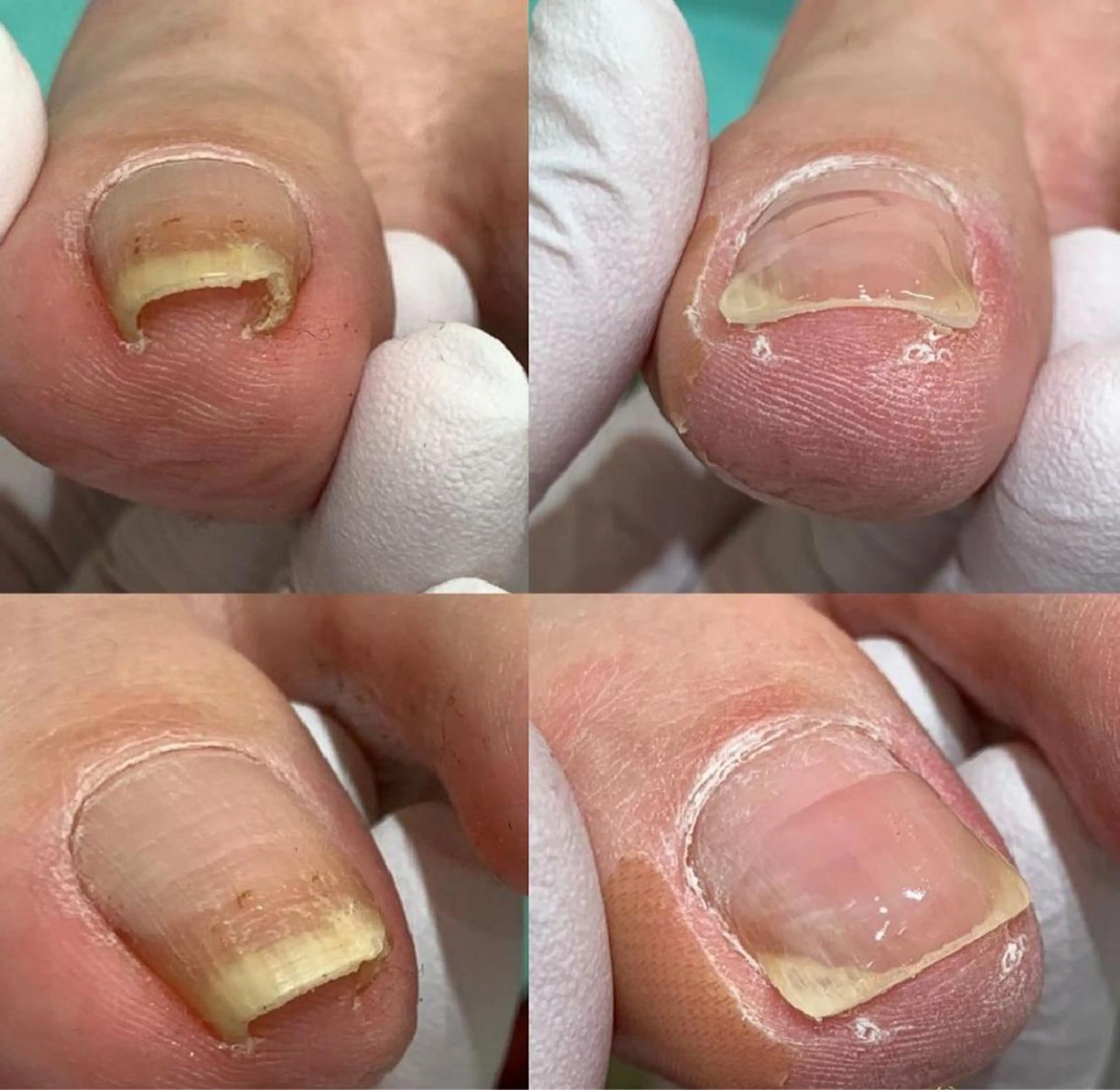 【巻き爪・陥入爪】🉐🉐【再来2週間以内限定❕】1爪の巻き爪補正✨痛み💥皮ふに沈み込んだ爪もキレイにします✨の写真