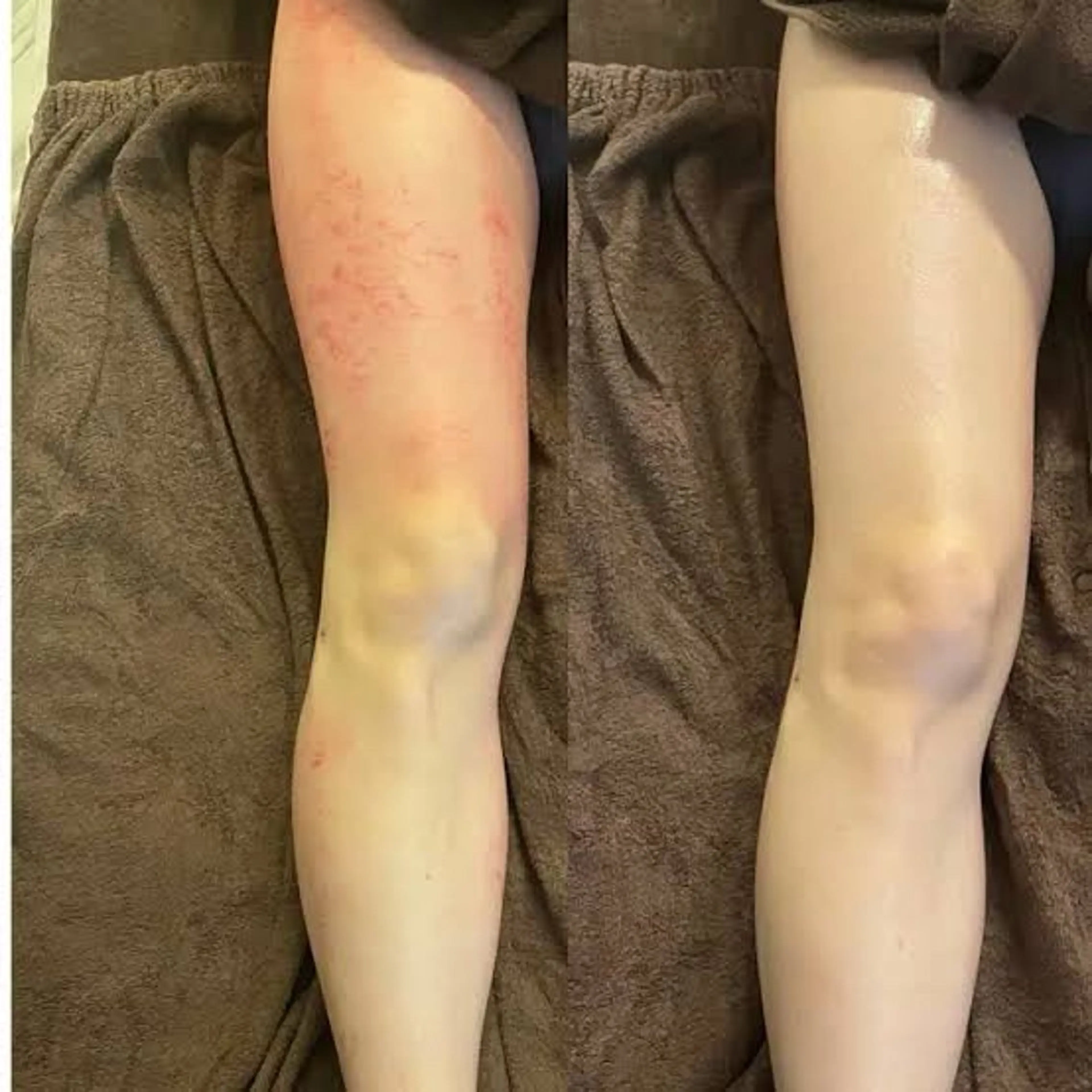 最強セル脂肪ケア♥️【大人気】スライドカッピング痩身 60分💥✨の写真