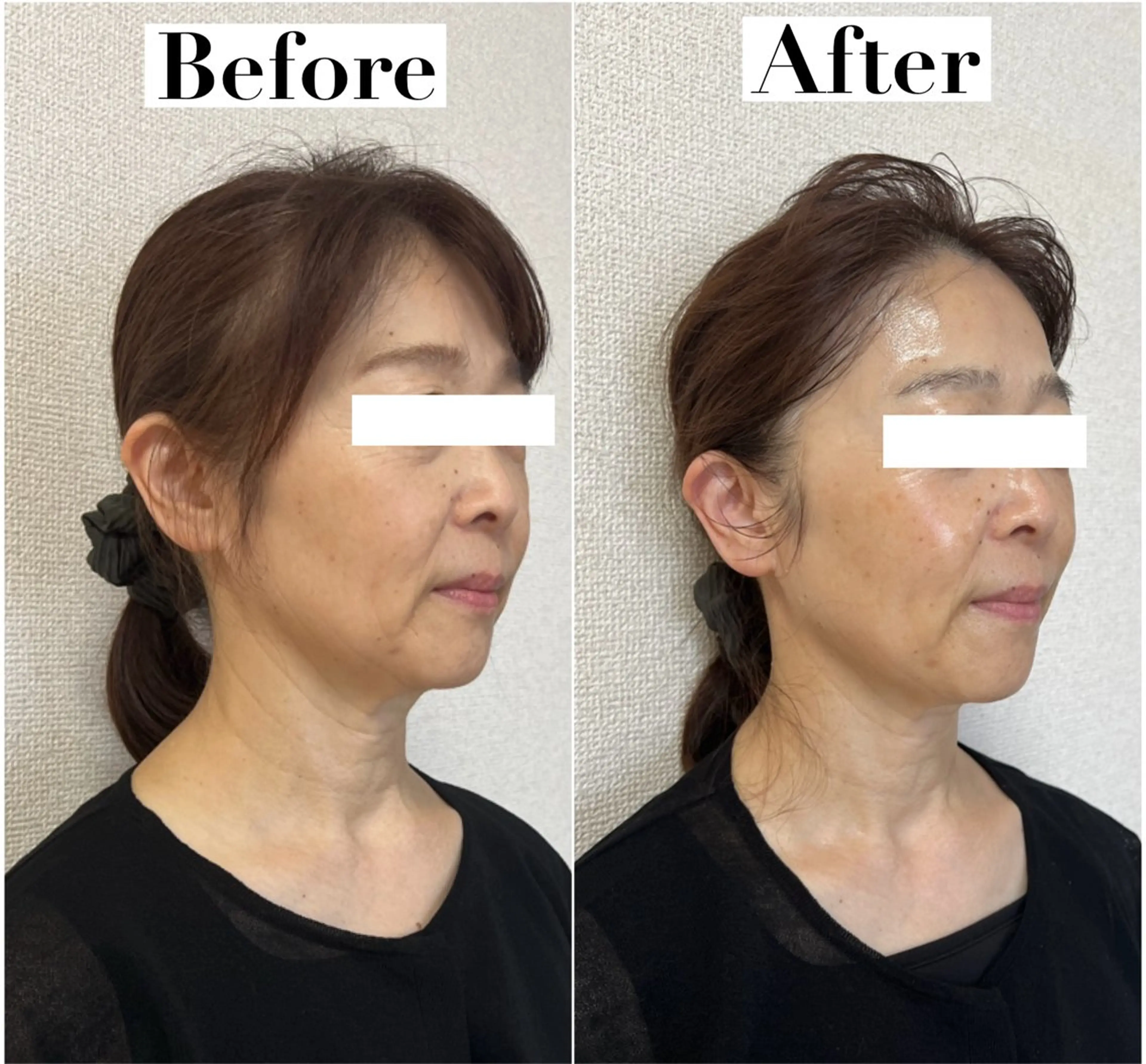 フェイスライン&たるみのお悩みにオーダーメイド施術【肌ケア付】の写真