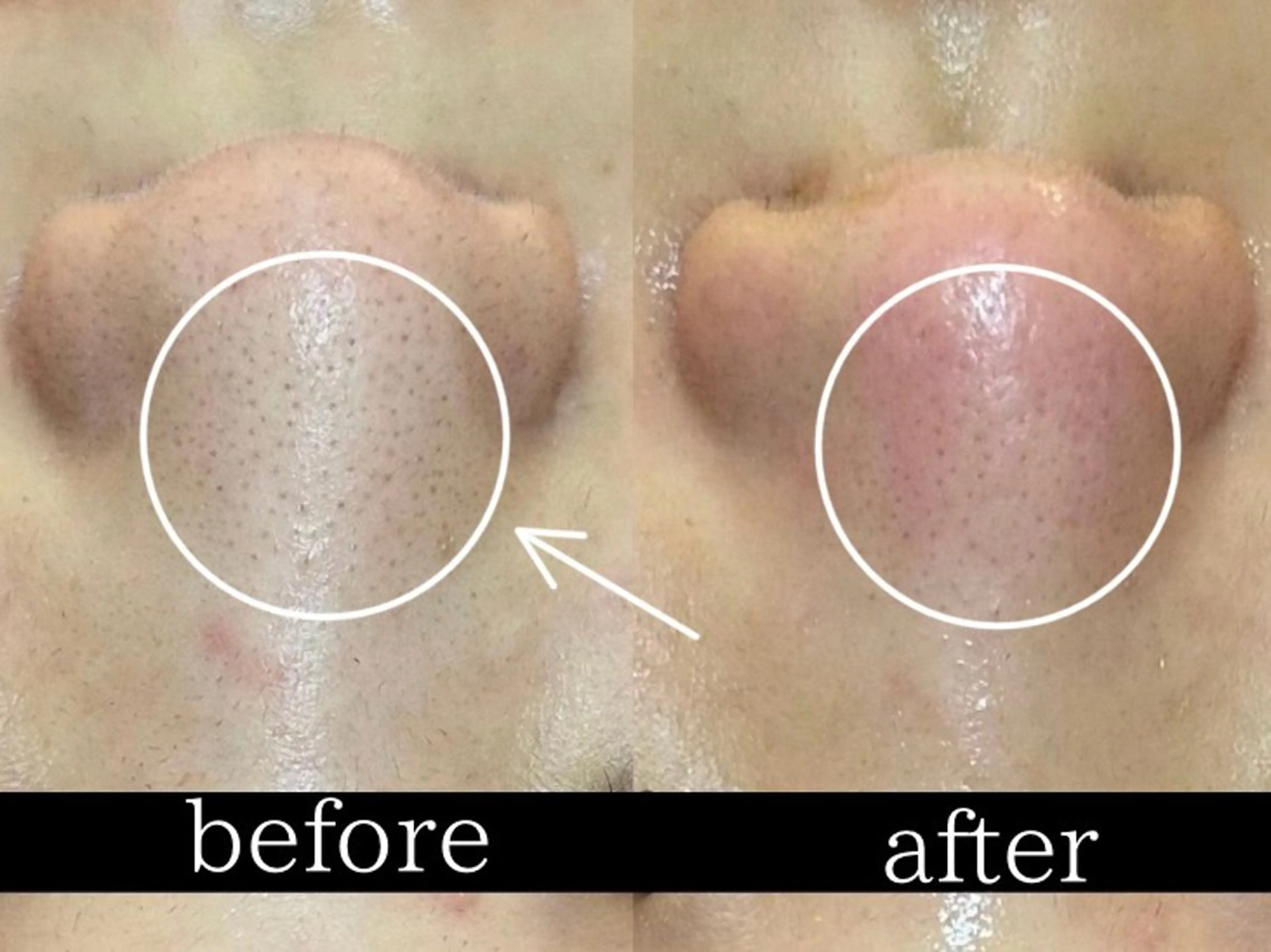 【毛穴洗浄】ハイドラフェイシャル全顔+首の写真