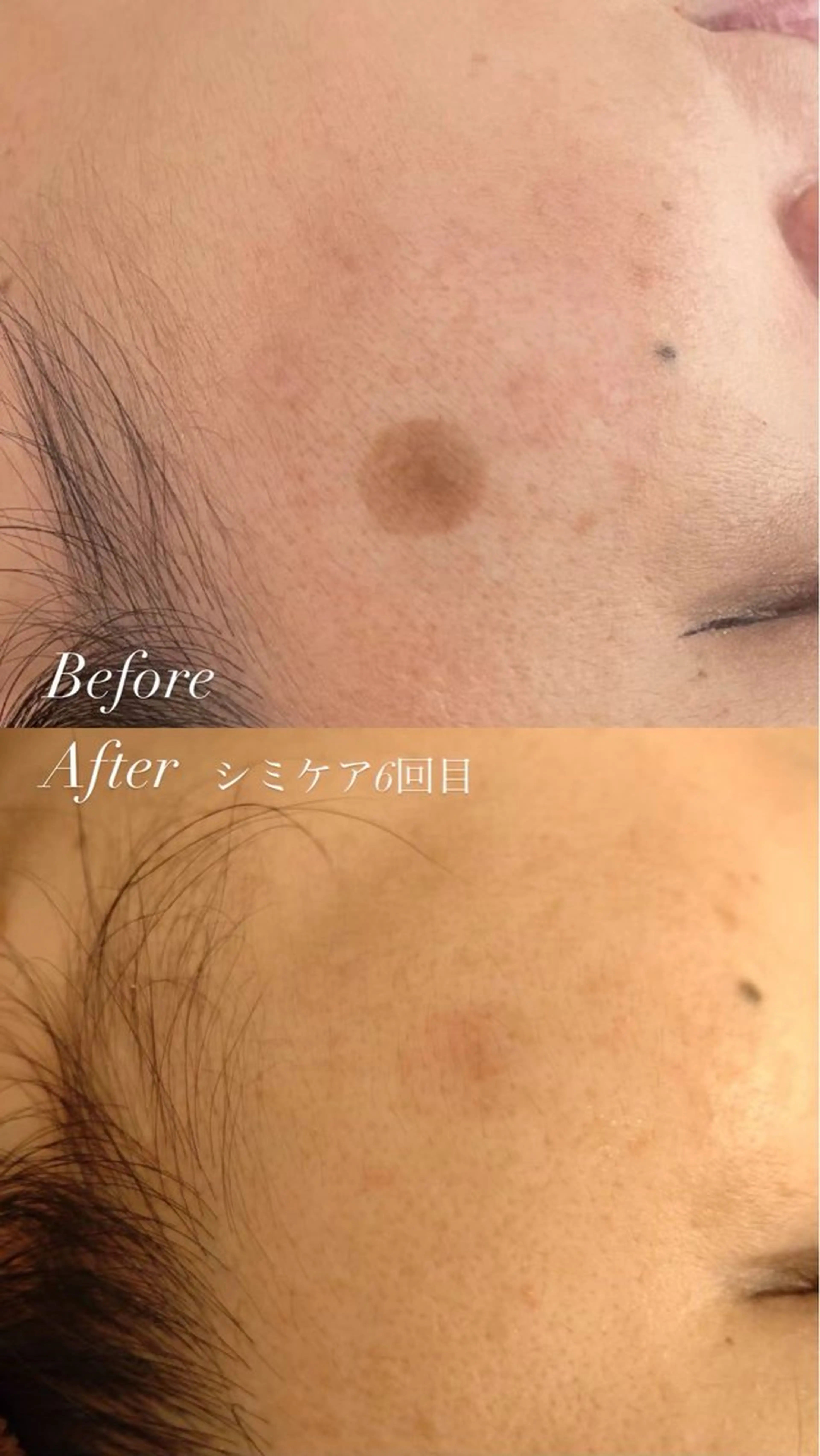 【シミ集中ケア】気になるシミをピンポイント改善✨の写真
