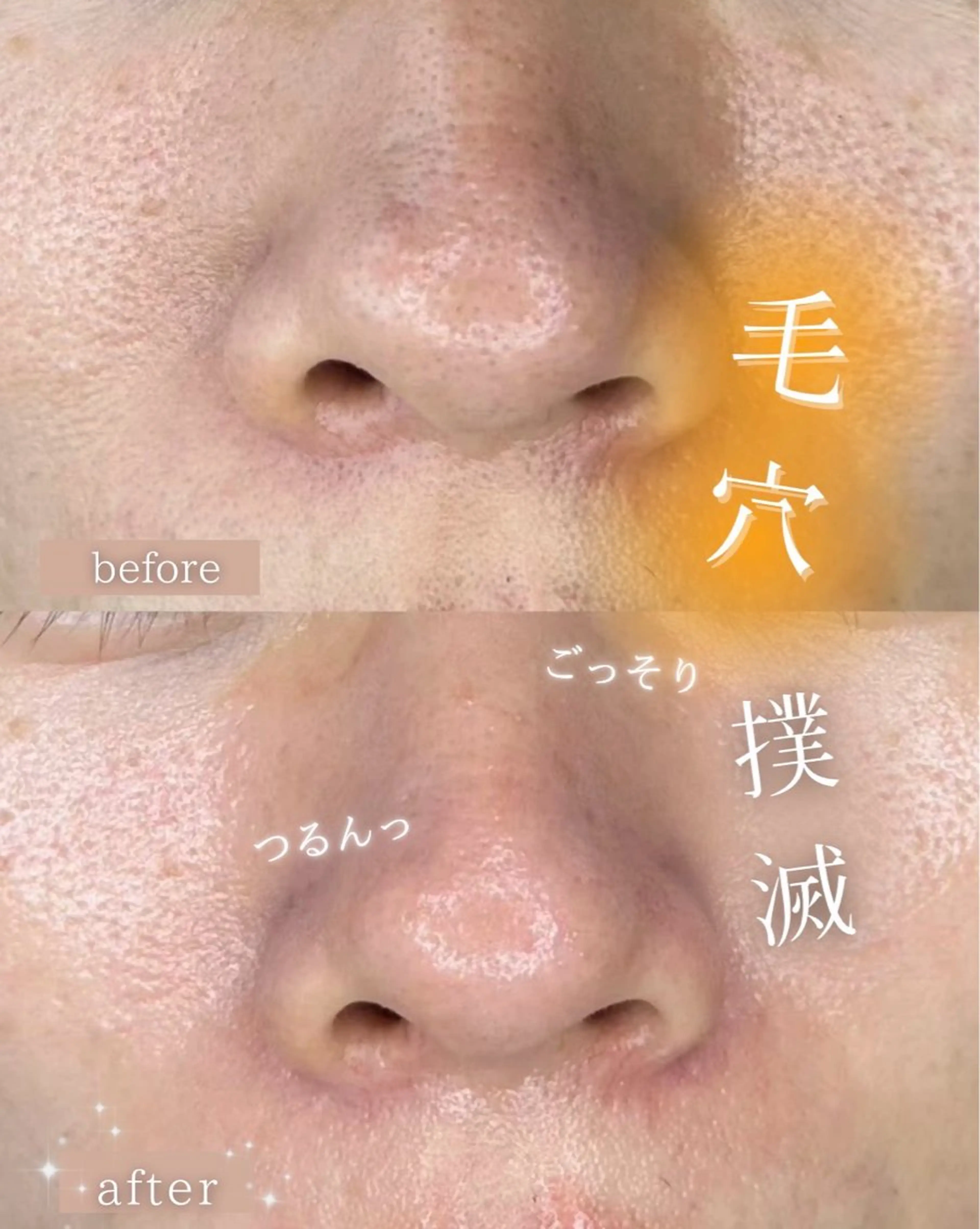 【毛穴角質ケア】コラーゲン顔脱毛+毛穴洗浄の写真