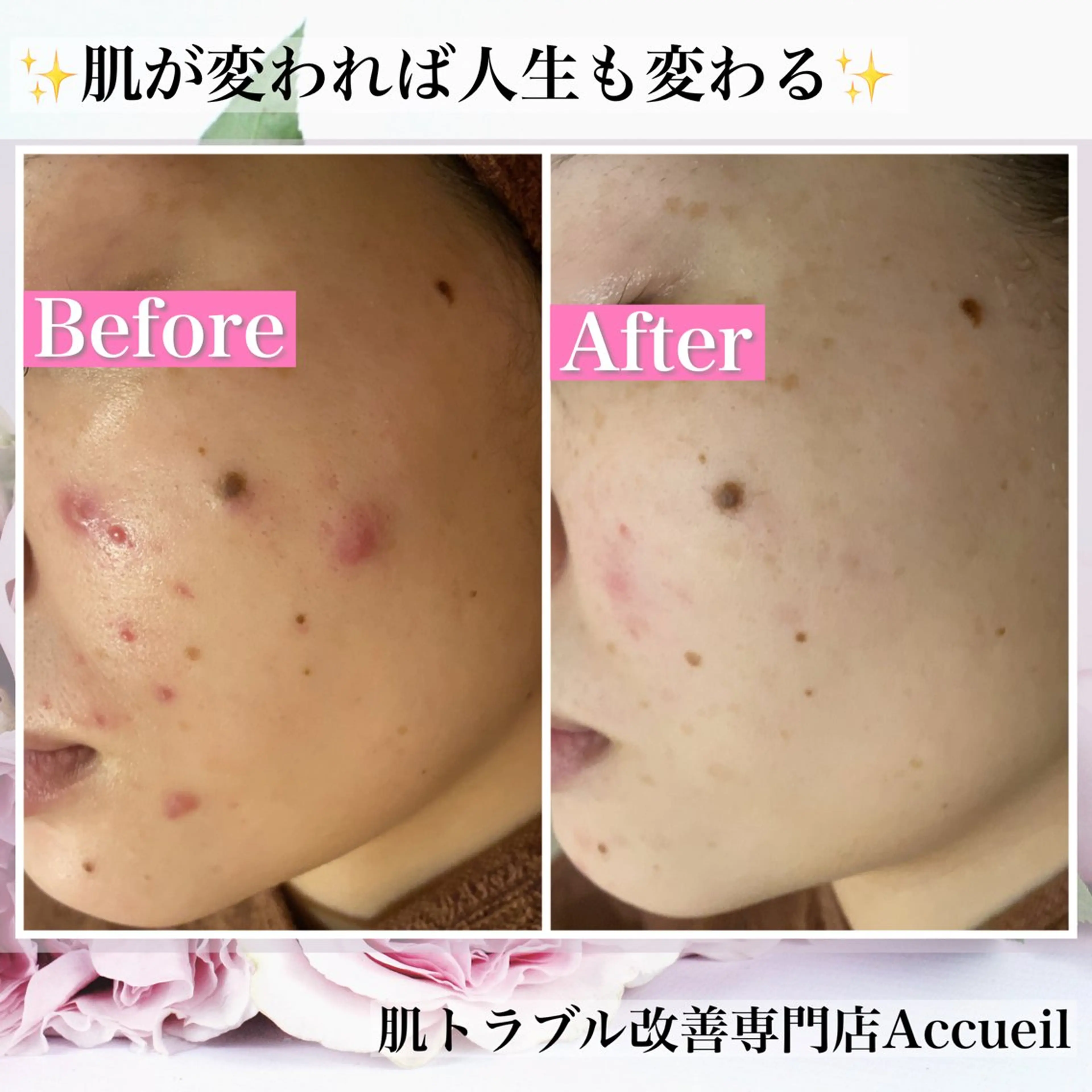 エステ リラク ニキビ・肌質改善専門 ♡人生が変わるサロンのエステ・リラクイメージ