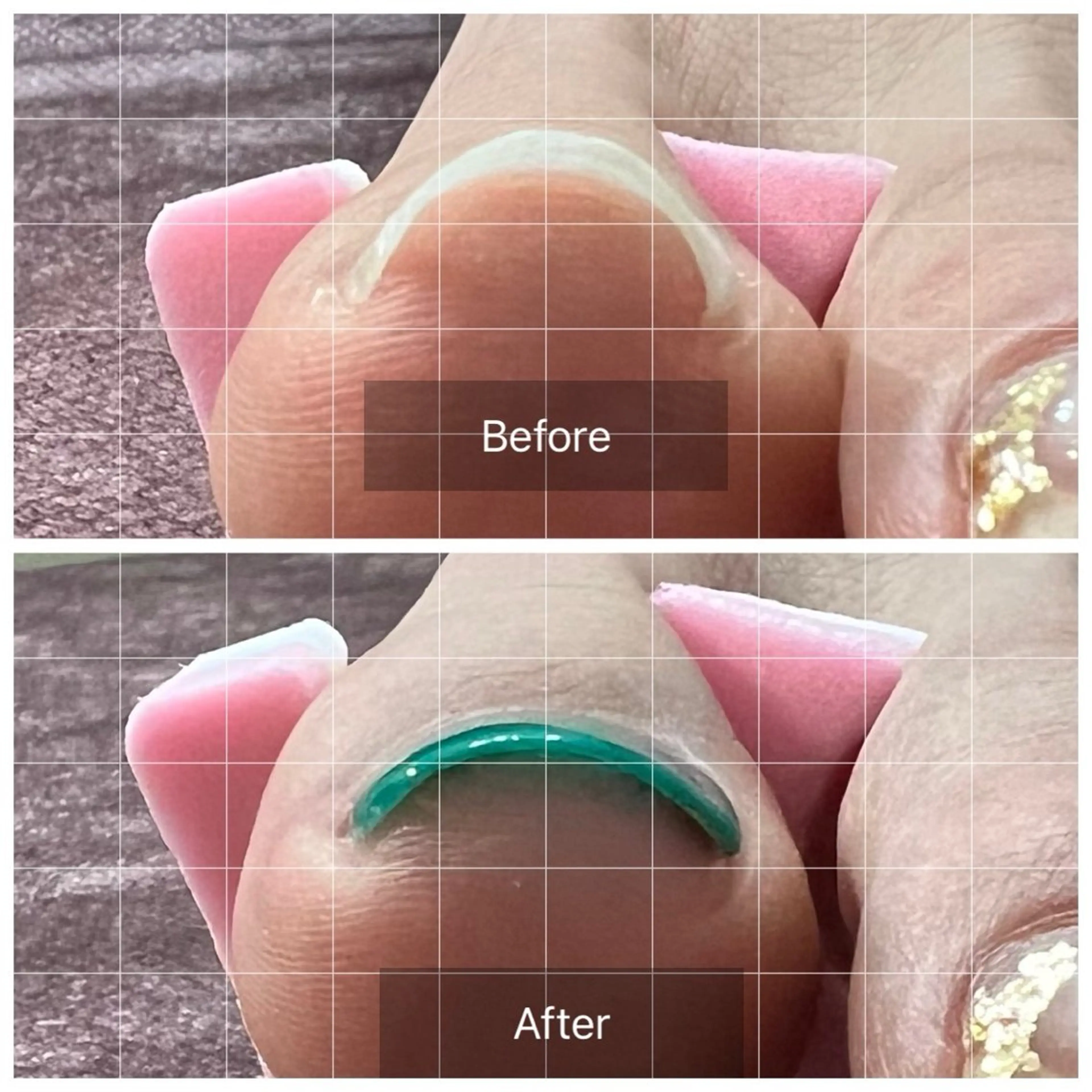 巻き爪UPジェル オフなしの写真