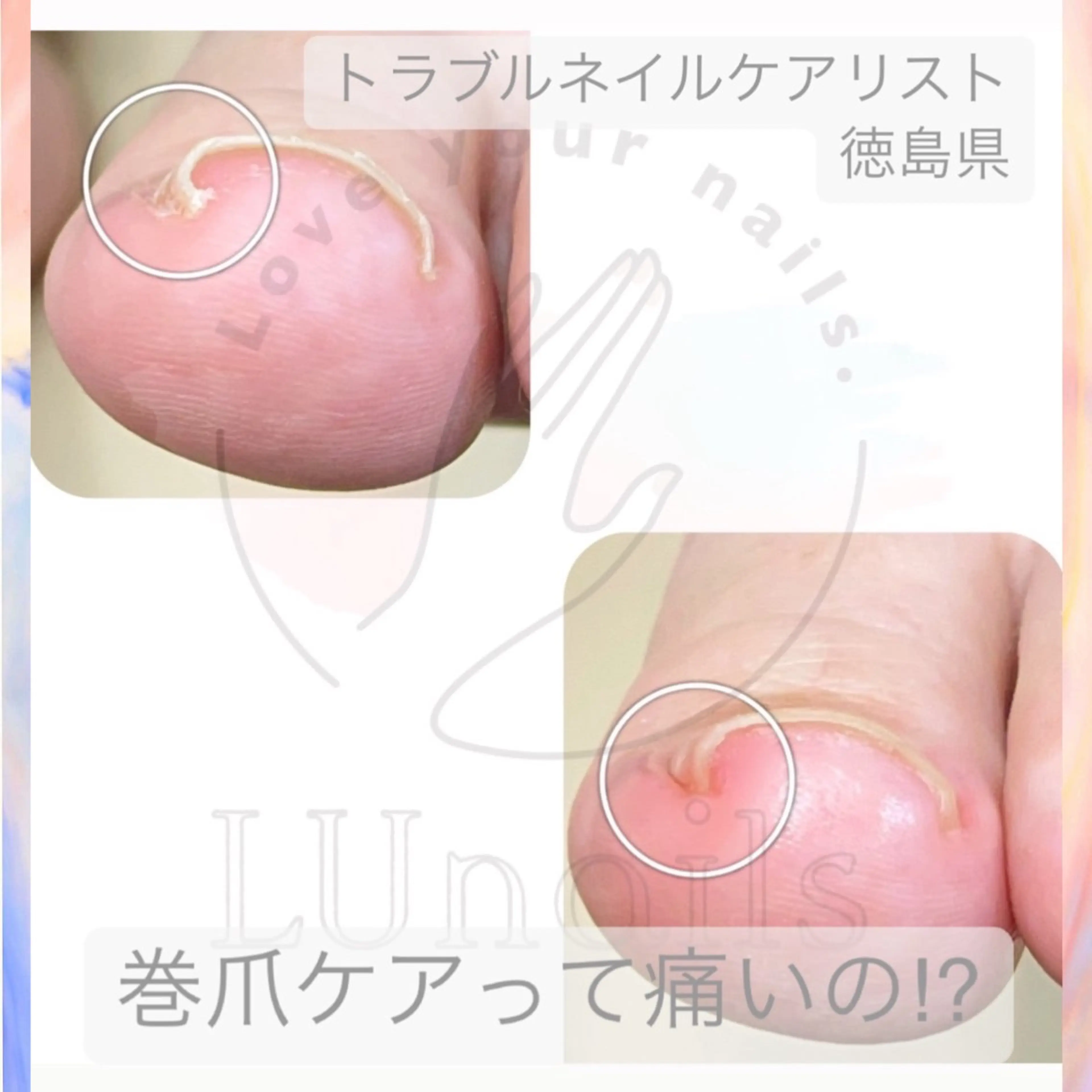 フットの巻爪モニター様募集‼️の写真