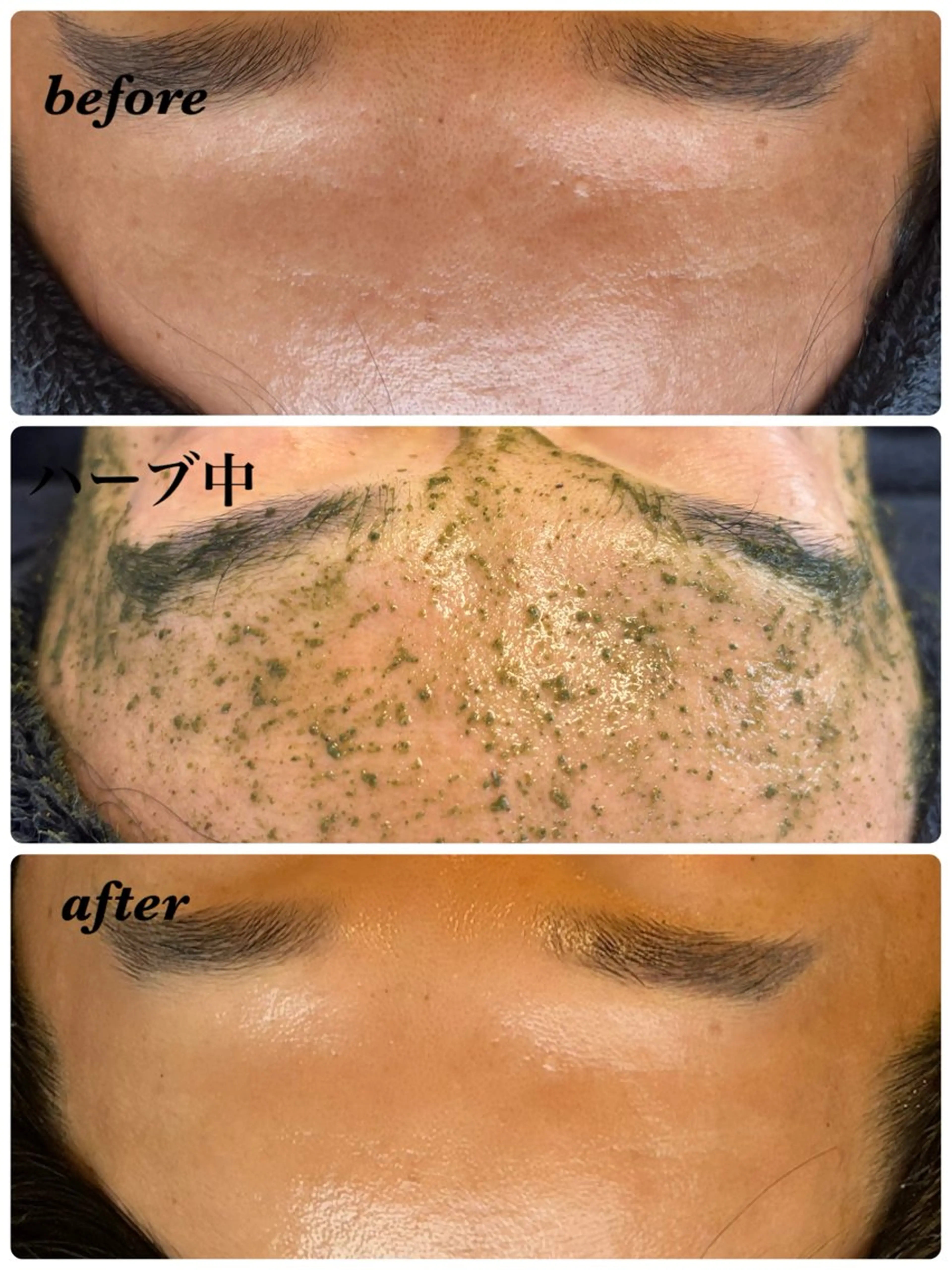 エステ ハーブピーリング/韓国肌管理/フェイシャル/毛穴洗浄/眉毛/顔脱毛【糸脱毛専門】rev所属・ハーブピーリング🌹 毛穴洗浄❤️眉waxのエステ・リラクイメージ