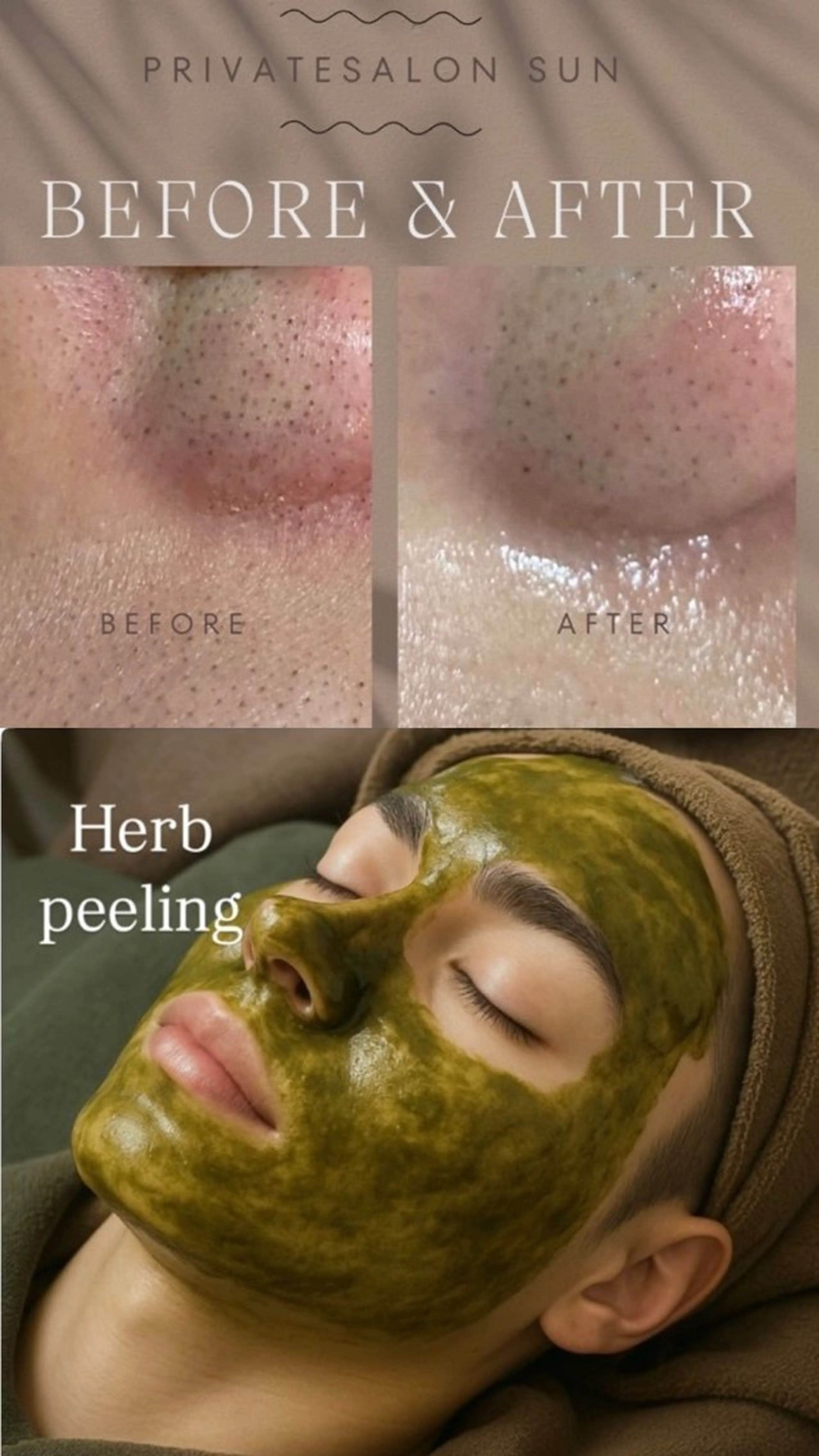 【12月限定🎄】 イチゴ鼻サヨウナラ！毛穴洗浄×ハーブピーリング40分 ［ニキビ、毛穴ケアで迷ったらコレ!］の写真