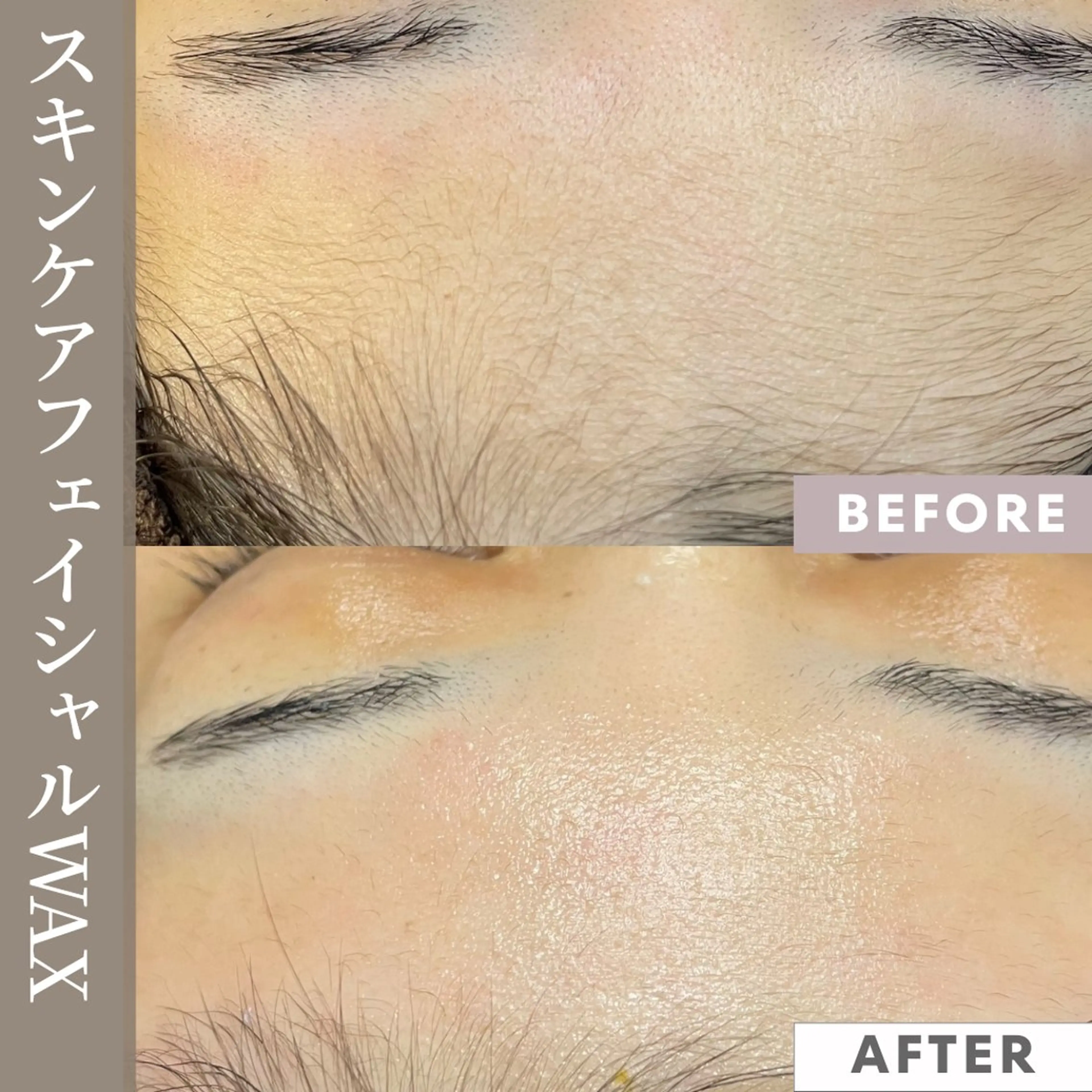 スキンケアワックス脱毛⭐️古い角質をしっかりキャッチ！艶々陶器肌を手に入れる💪✨の写真