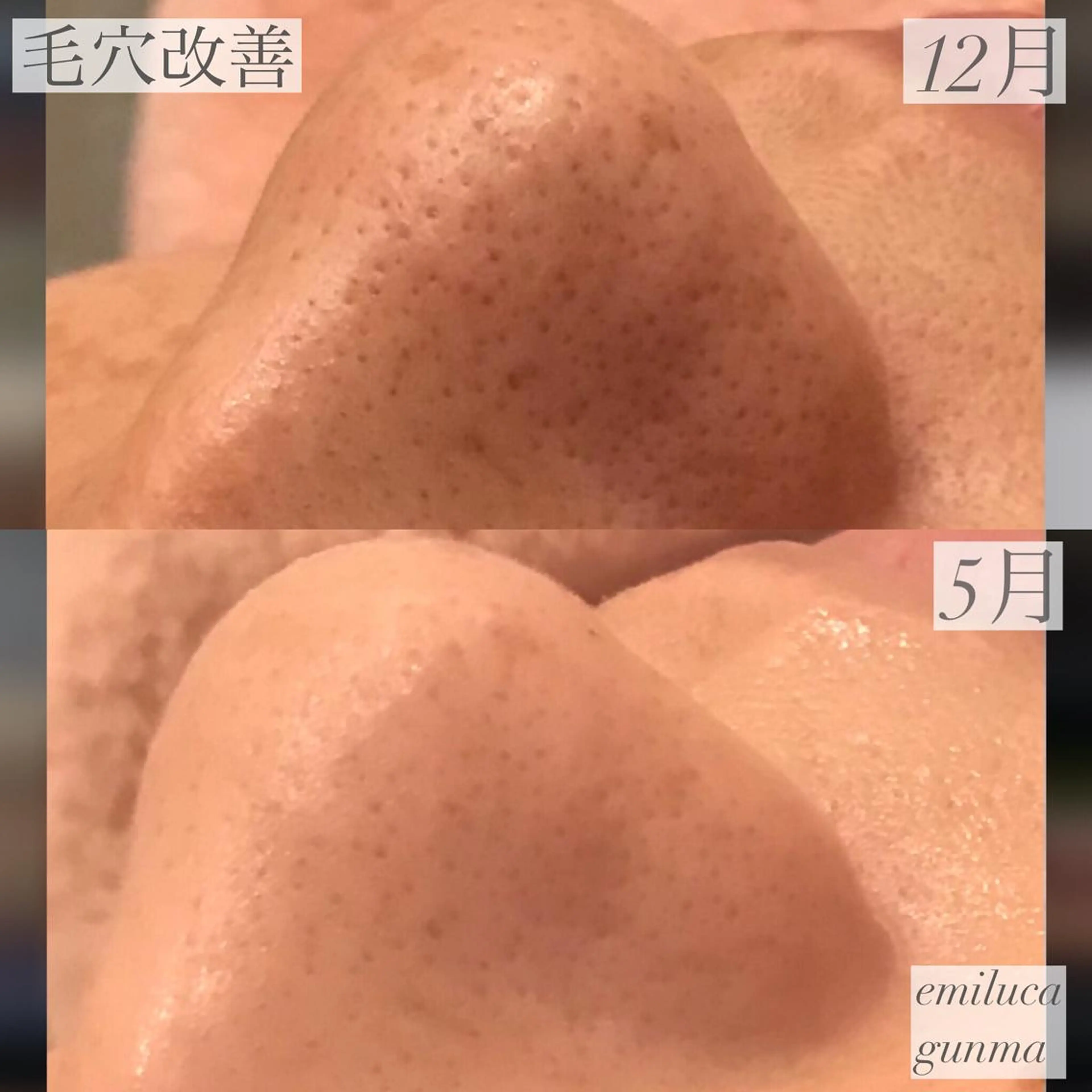 emiluca西目/ 毛穴洗浄/細胞美容のエステ・リラクイメージ