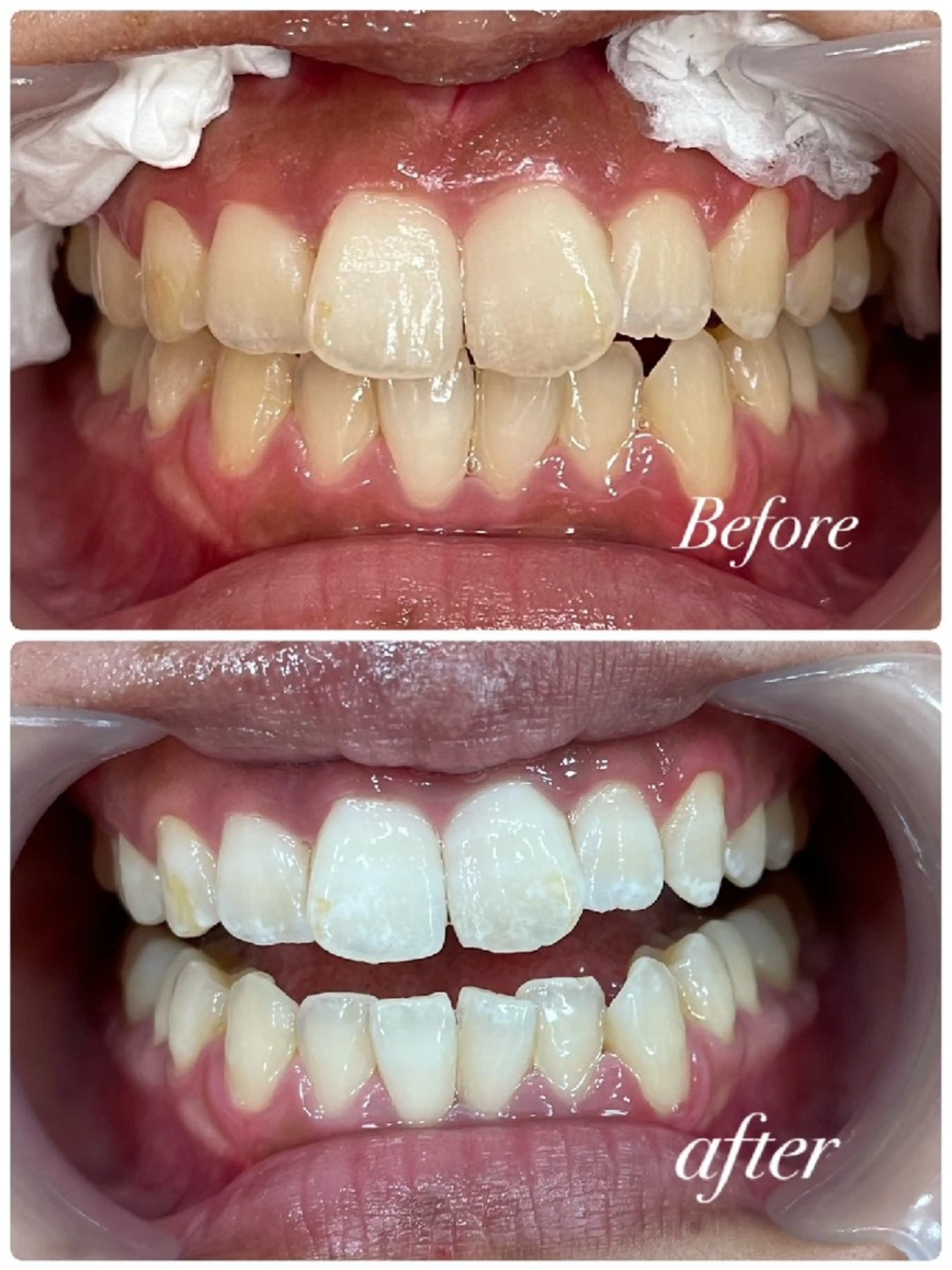 ディープホワイトニング50分照射の写真