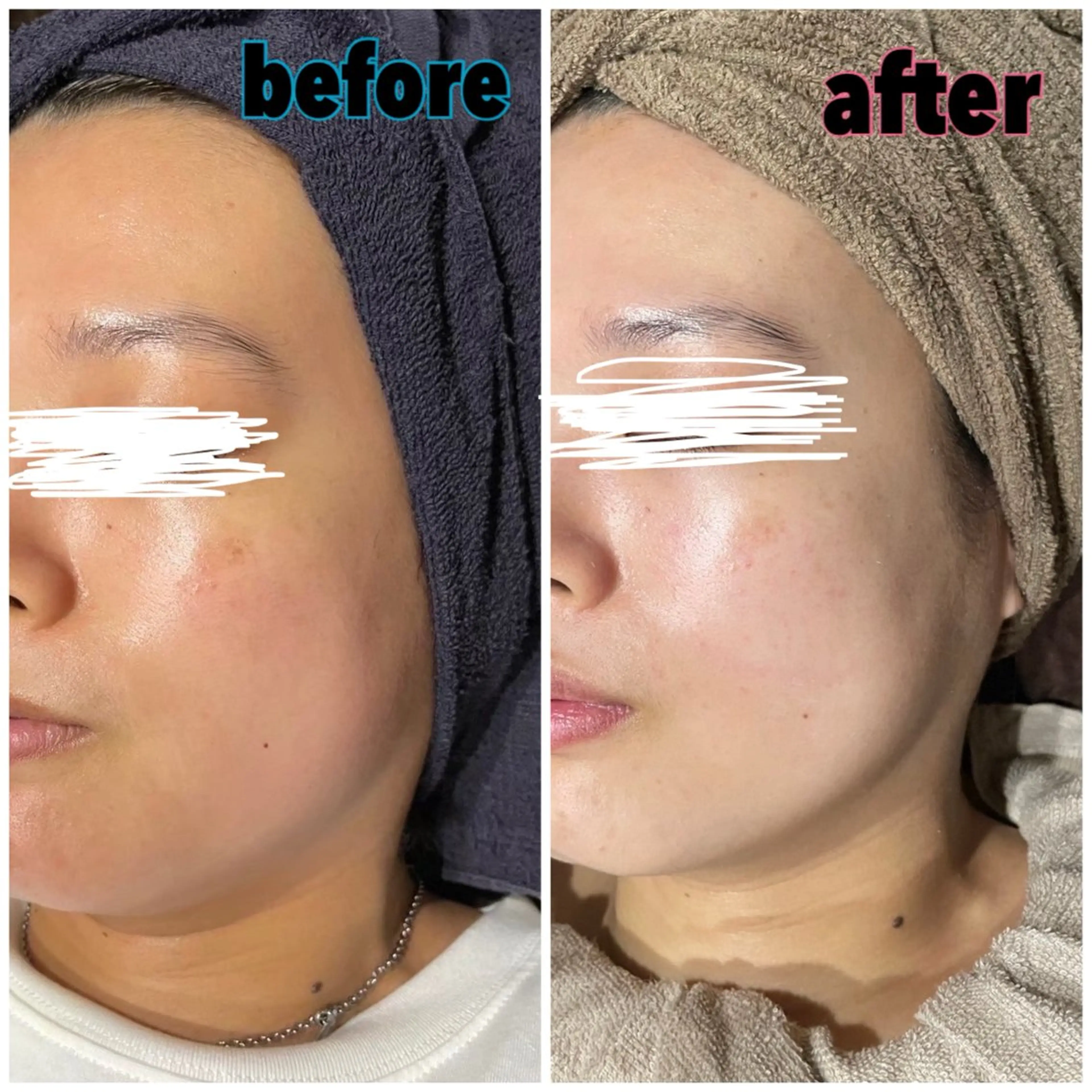 ◎光フェイシャル 【首肩デコルテマッサージ付き】シミ、そばかす、いちご鼻、黒ずみの写真