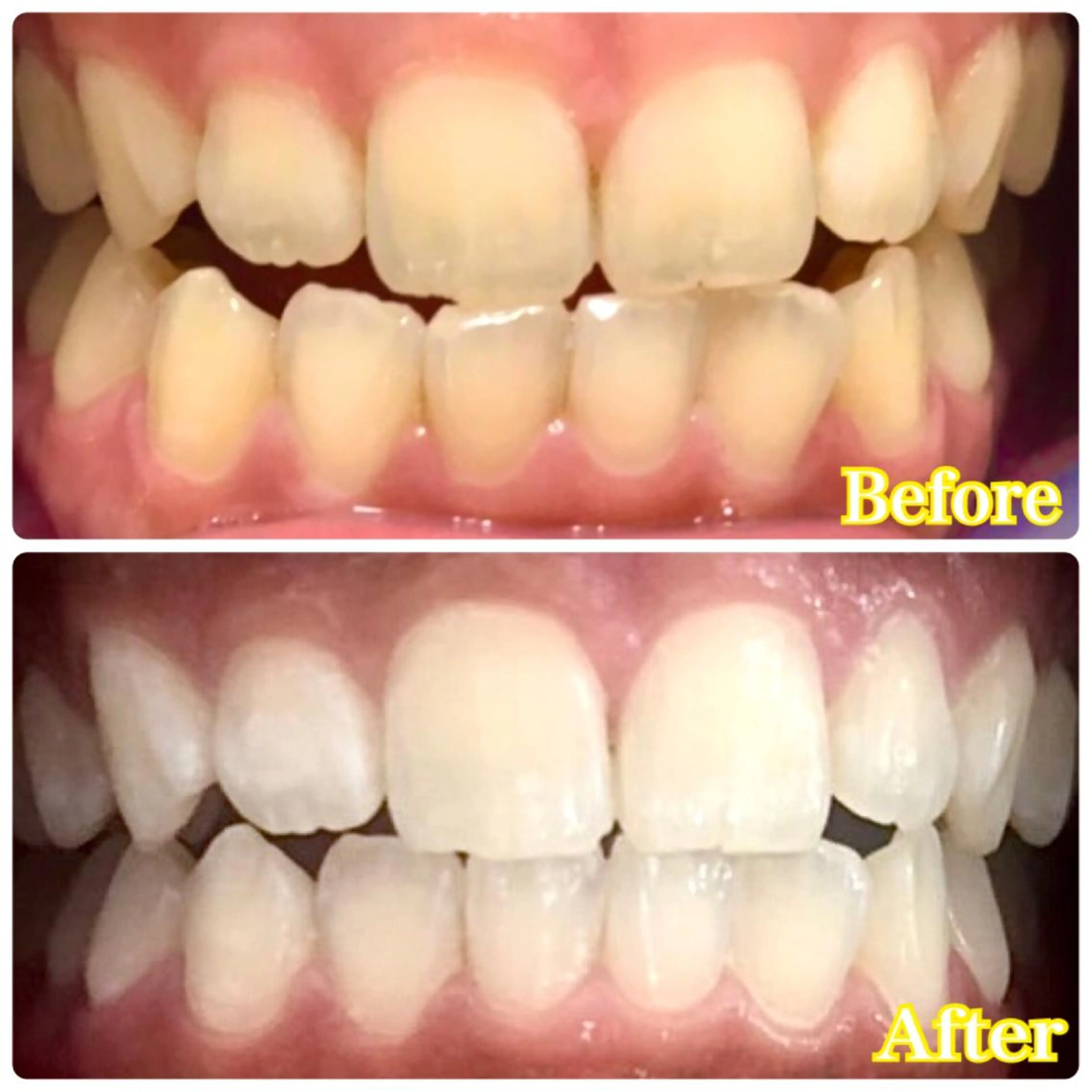 祝⭐全国最安値⭐歯科医提携サロン🦷ホワイトニング3回照射4000円♪1日完了🌈芸能人御用達サロン❤の写真