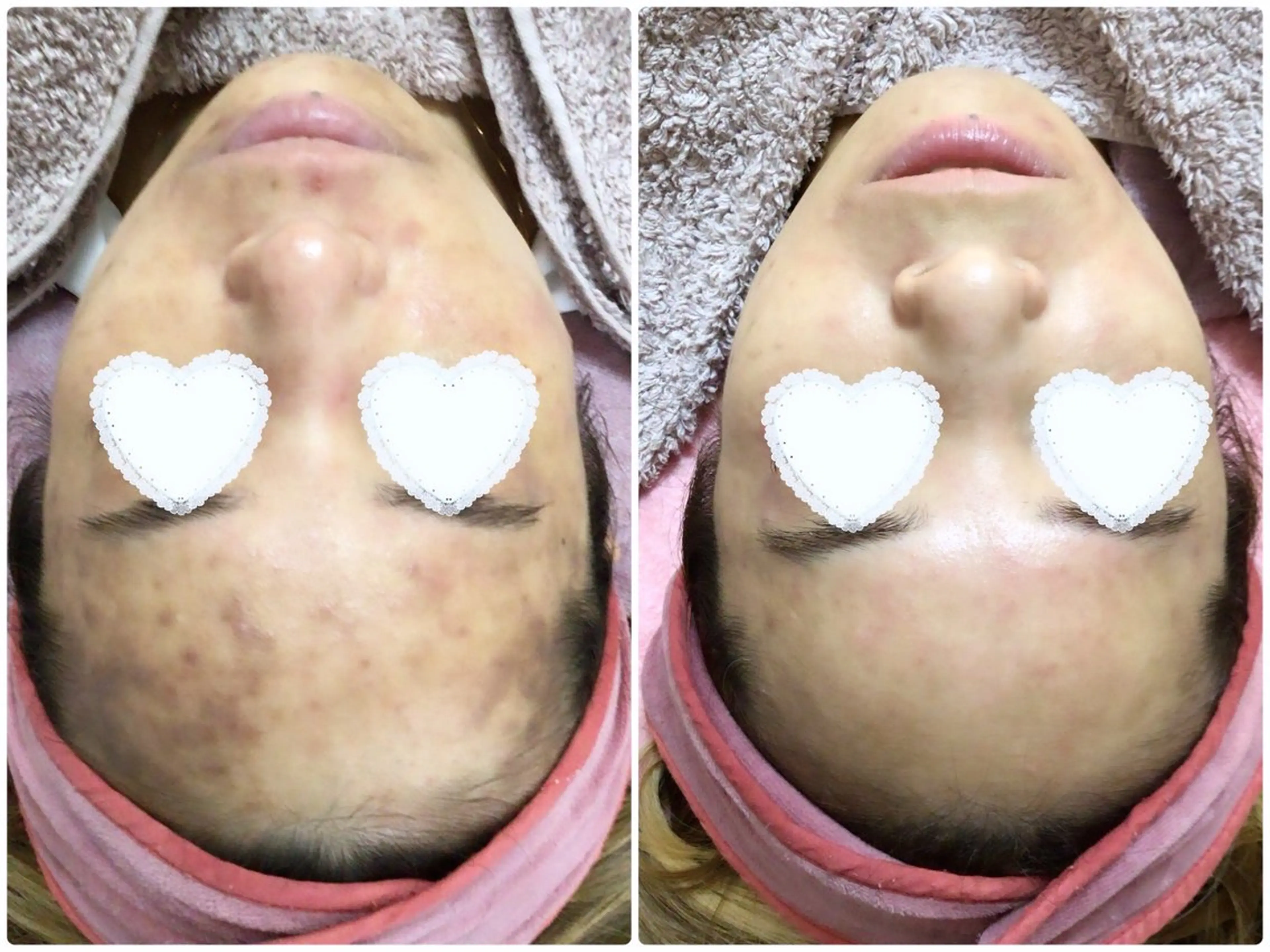 【ニキビ肌質改善】《プラズマゼノデュアル》救世主‼️トラブル肌/アトピーの方必見！殺菌＆浸透  最新サイエンス美容！の写真