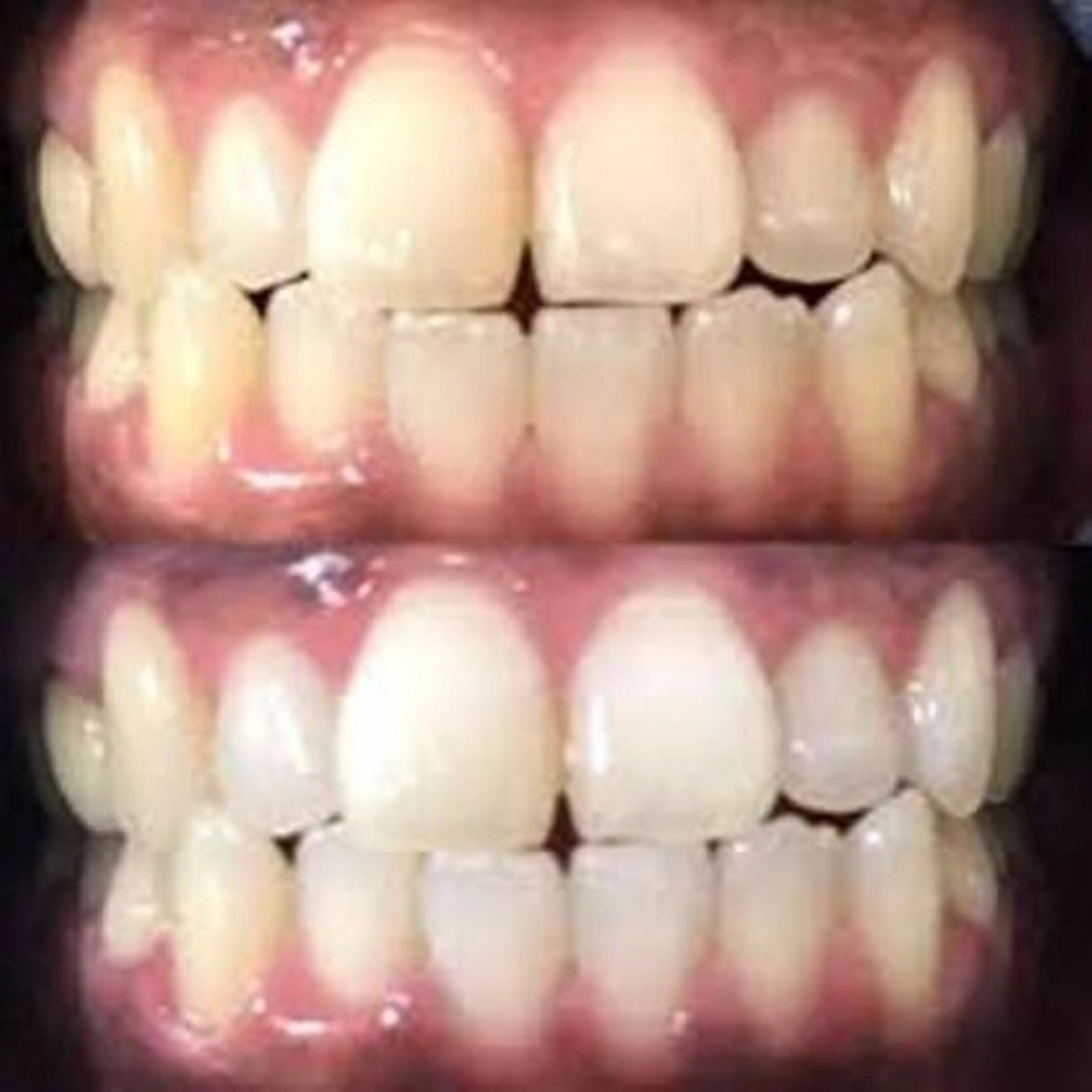 ✨ご新規様minimo限定✨4回照射×８分 セルフホワイトニングの写真