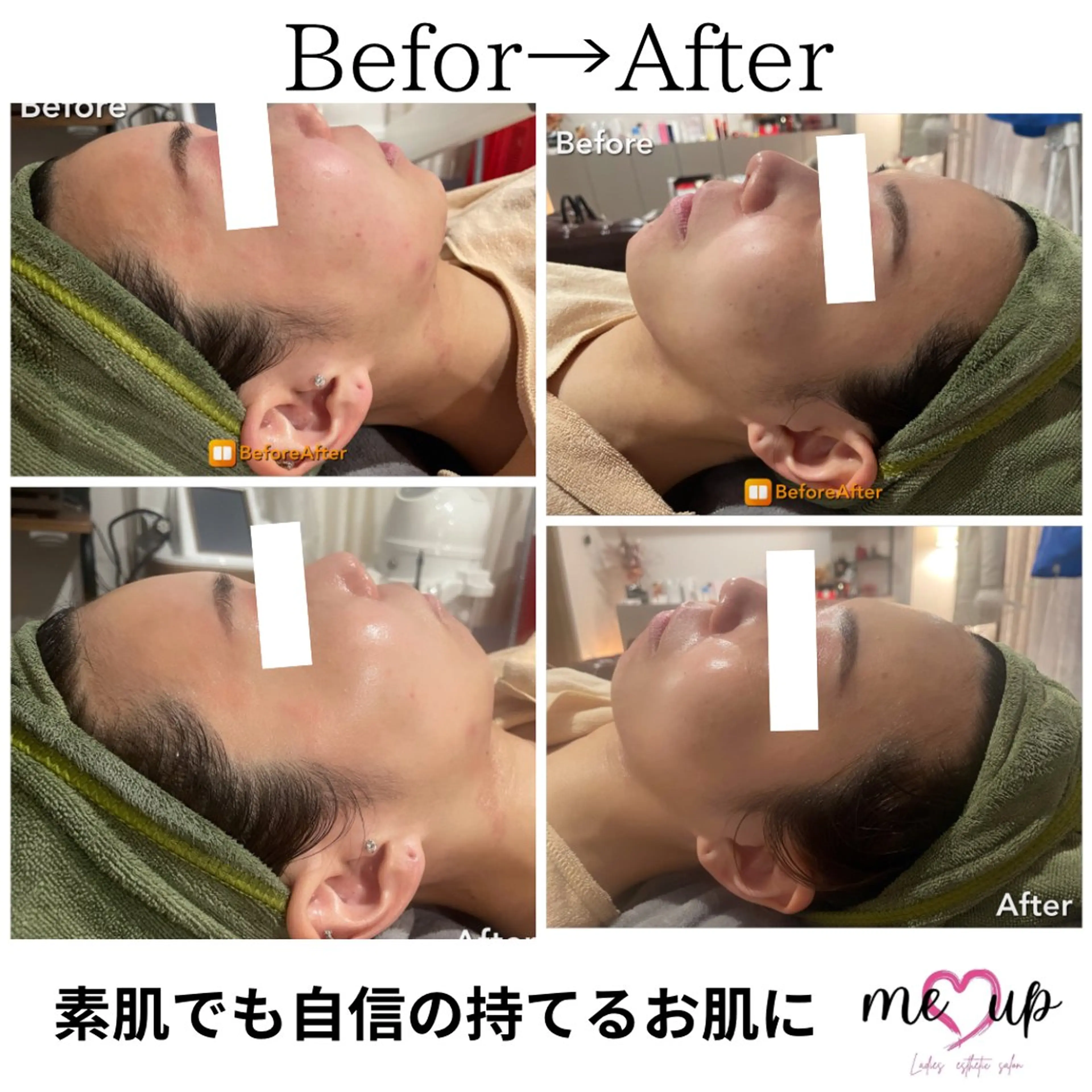 Meupニキビ専門店 背中/ハーブ/肌管理のその他イメージ