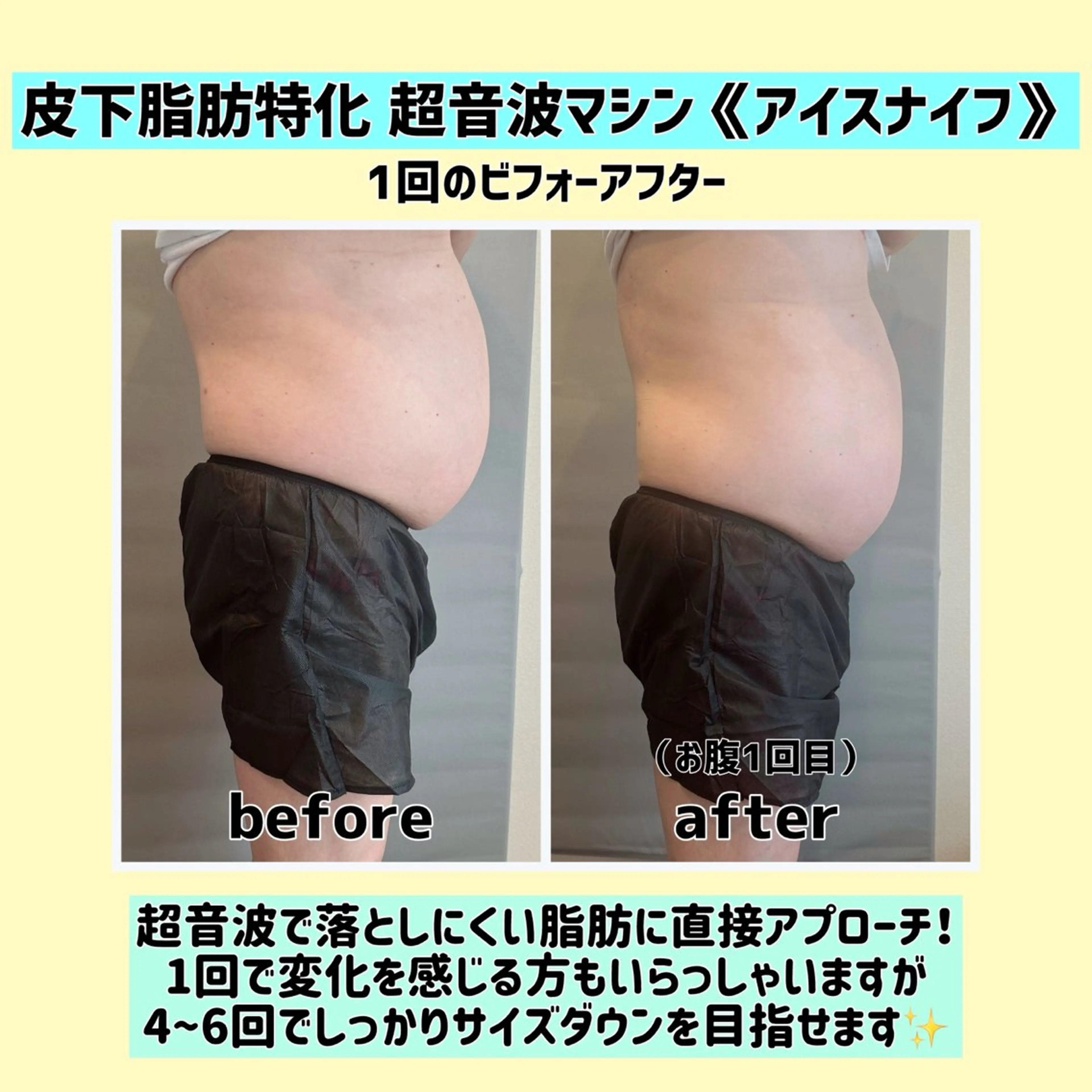 【写真モニター募集】皮下脂肪特化 超音波マシン《アイスナイフ》2部位の写真