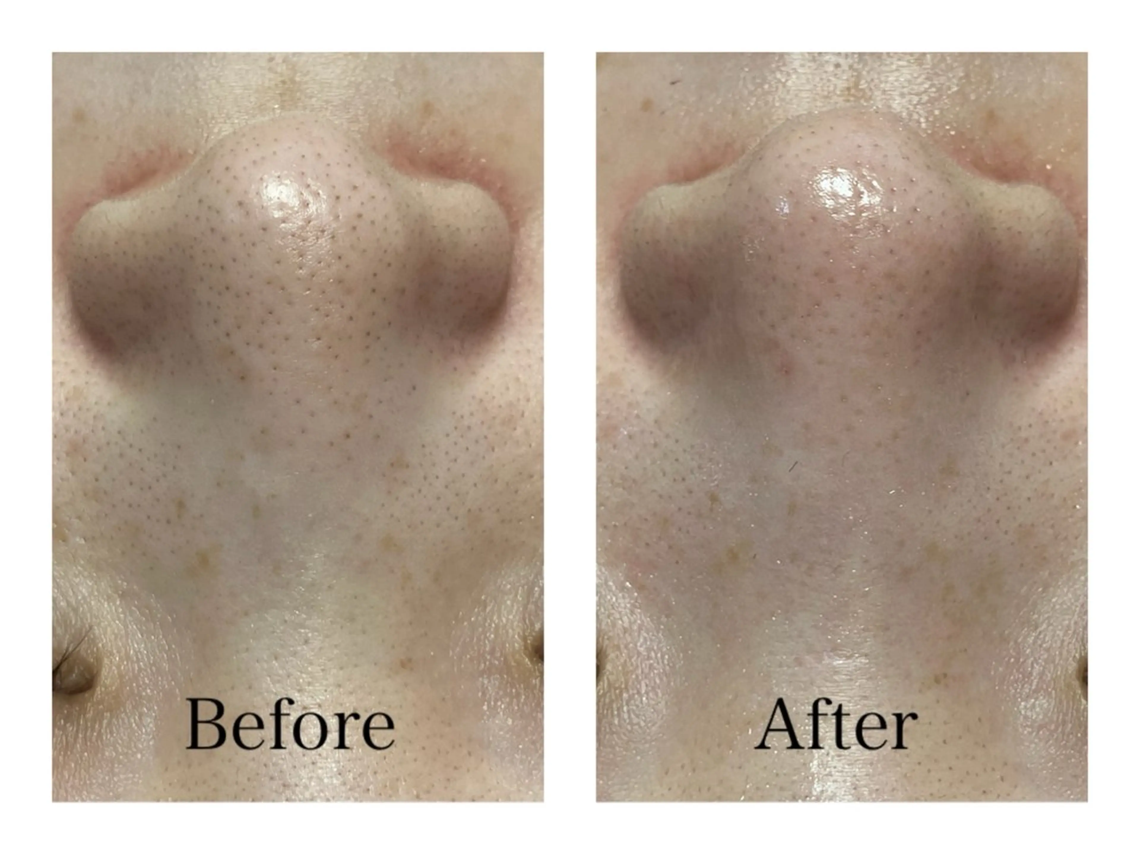 毛穴ｴｸｽﾄﾗｸｼｮﾝの写真