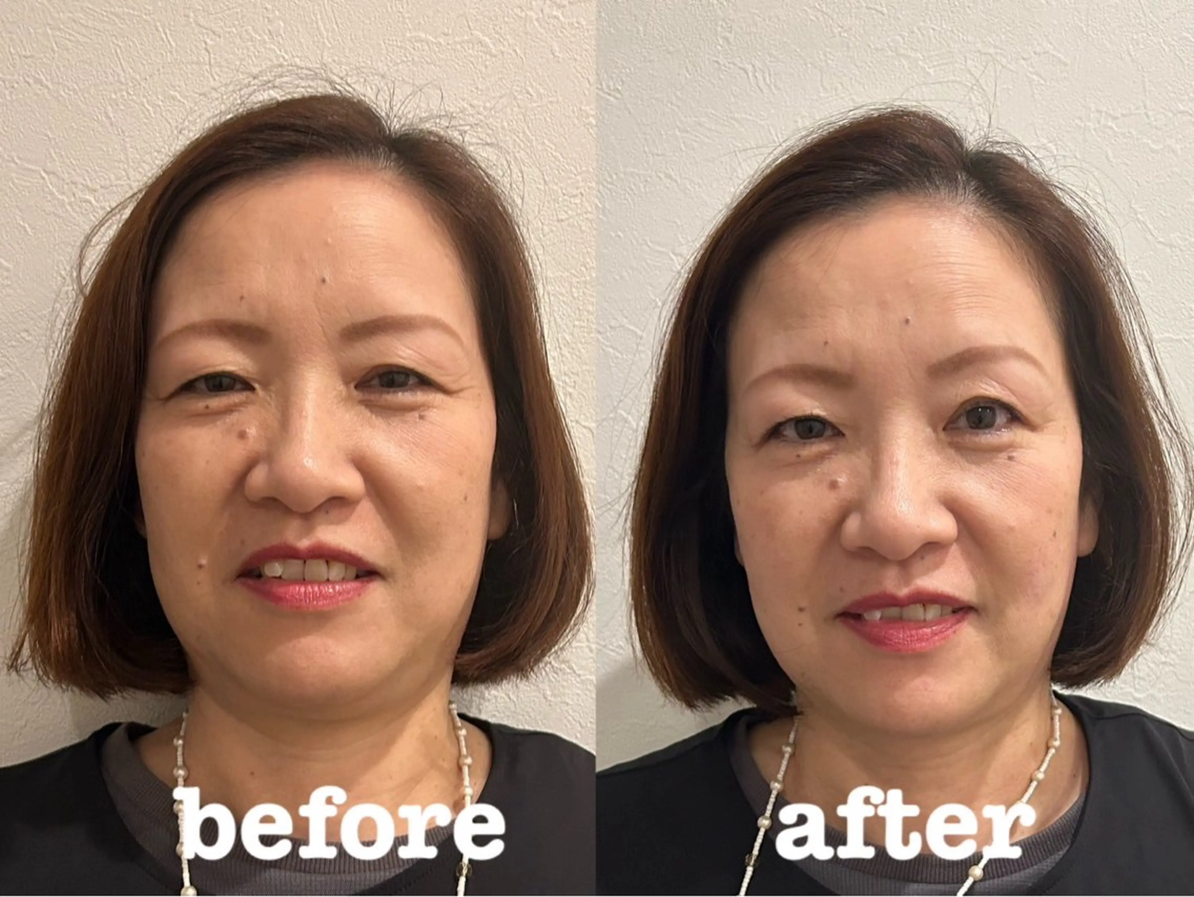 エステ リラク 美容鍼灸Solana所属・肌質改善×美容鍼 ゆいのエステ・リラクイメージ