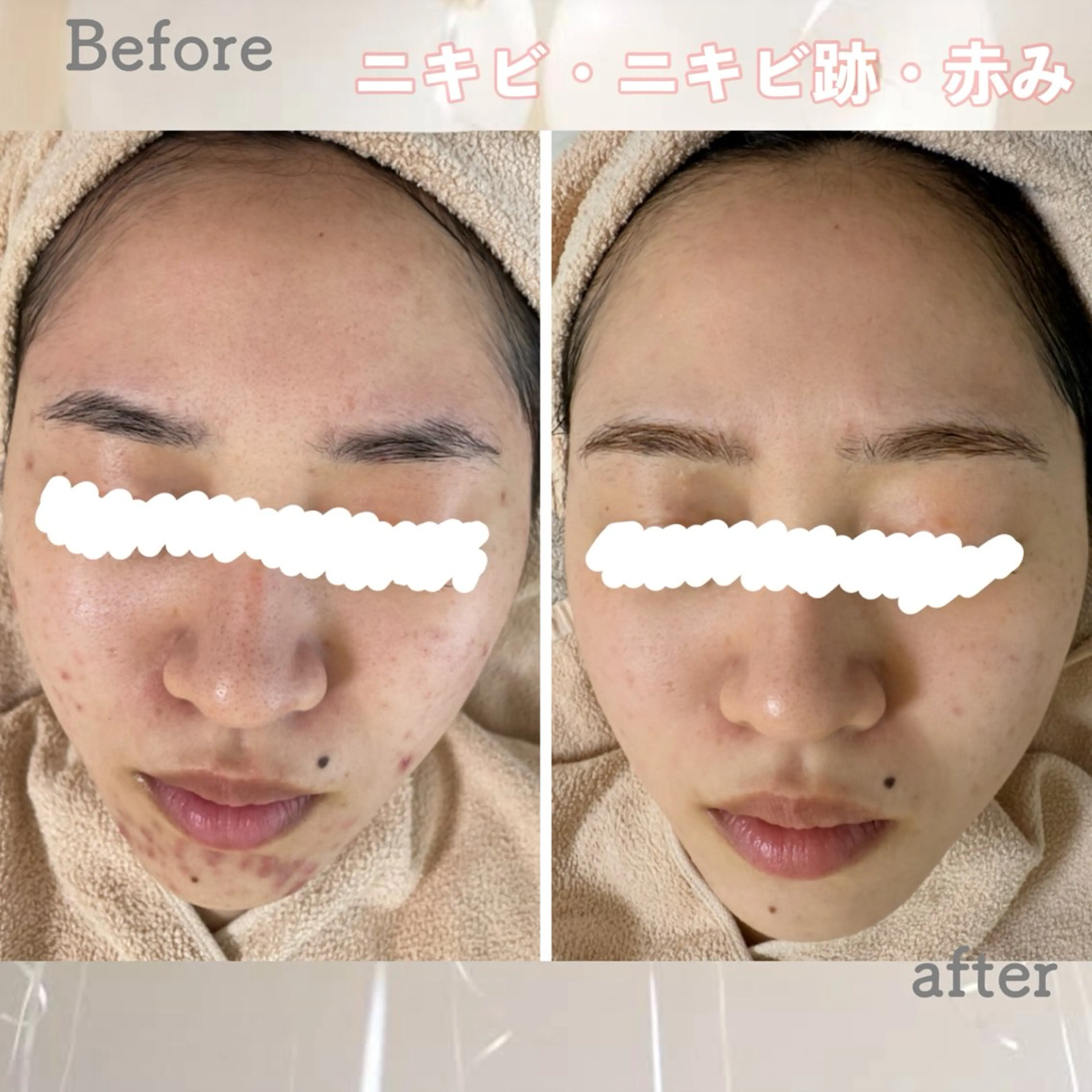 エステ ニキビ&跡改善サロン オーナー光木のエステ・リラクイメージ