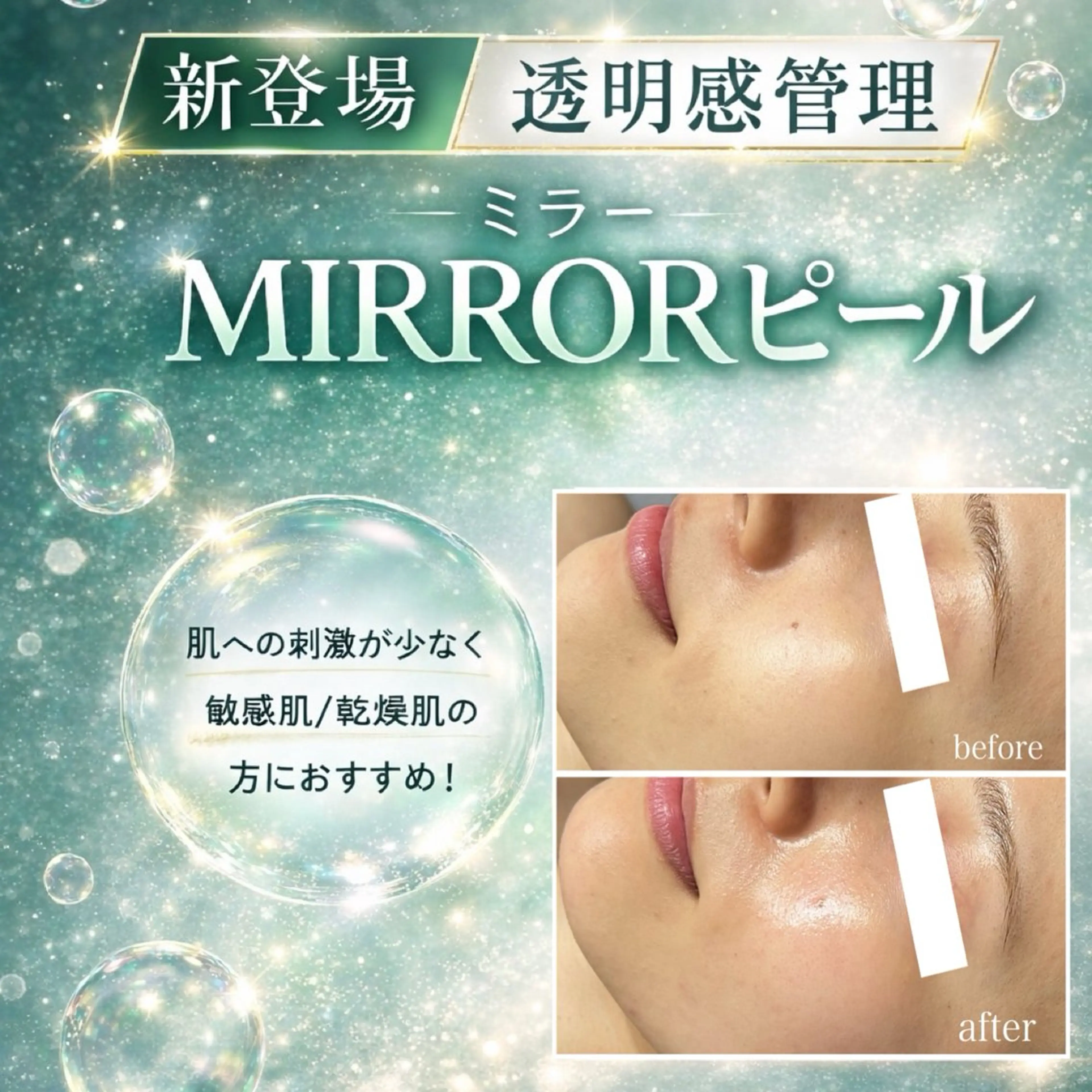 新メニュー☆透明肌管理【MIRRORピール】×プラズマ美容液導入の写真
