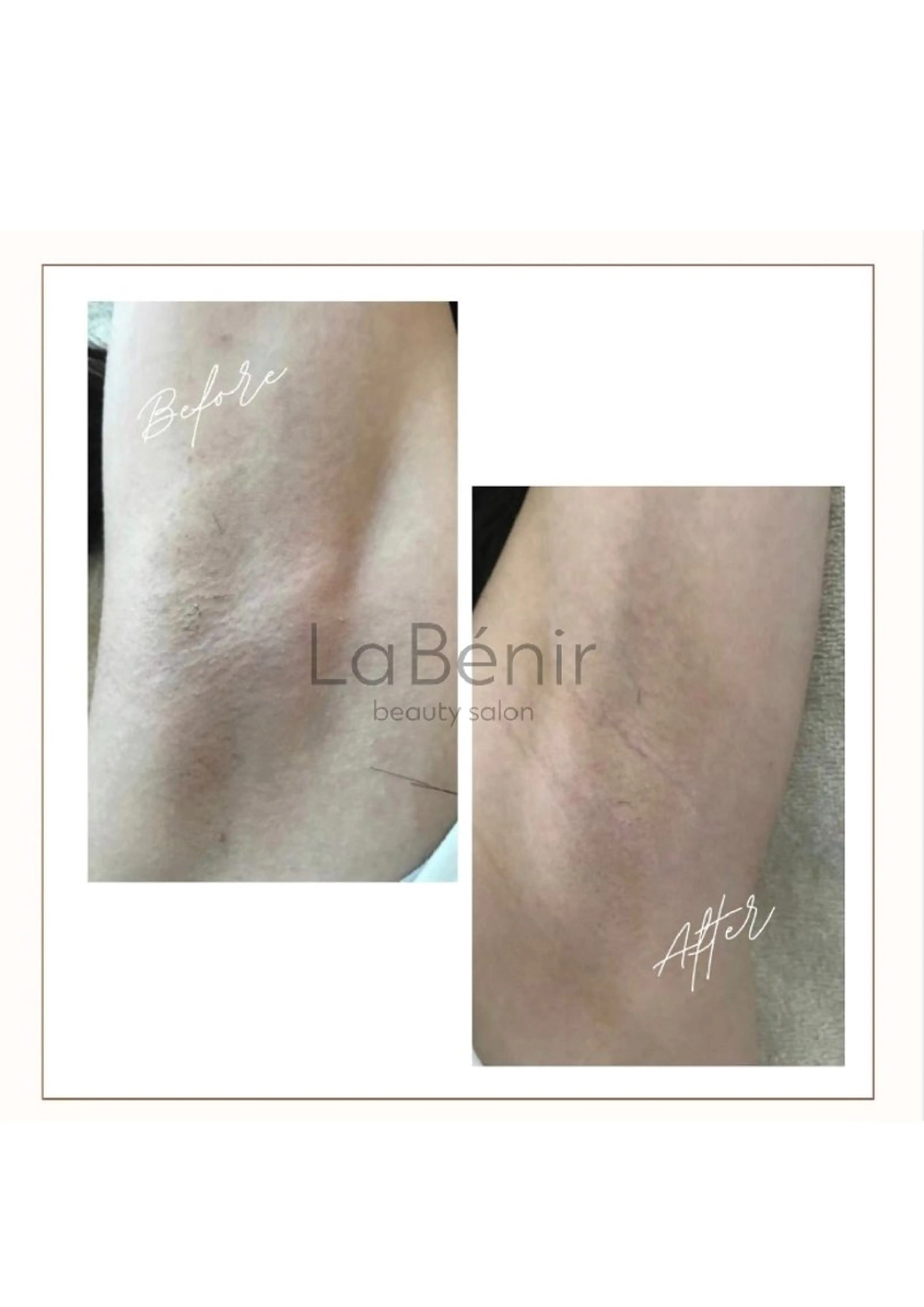 キッズ 脱毛 脱毛/美肌【皮膚科看 護師経営】ラベニールのエステ・リラクイメージ