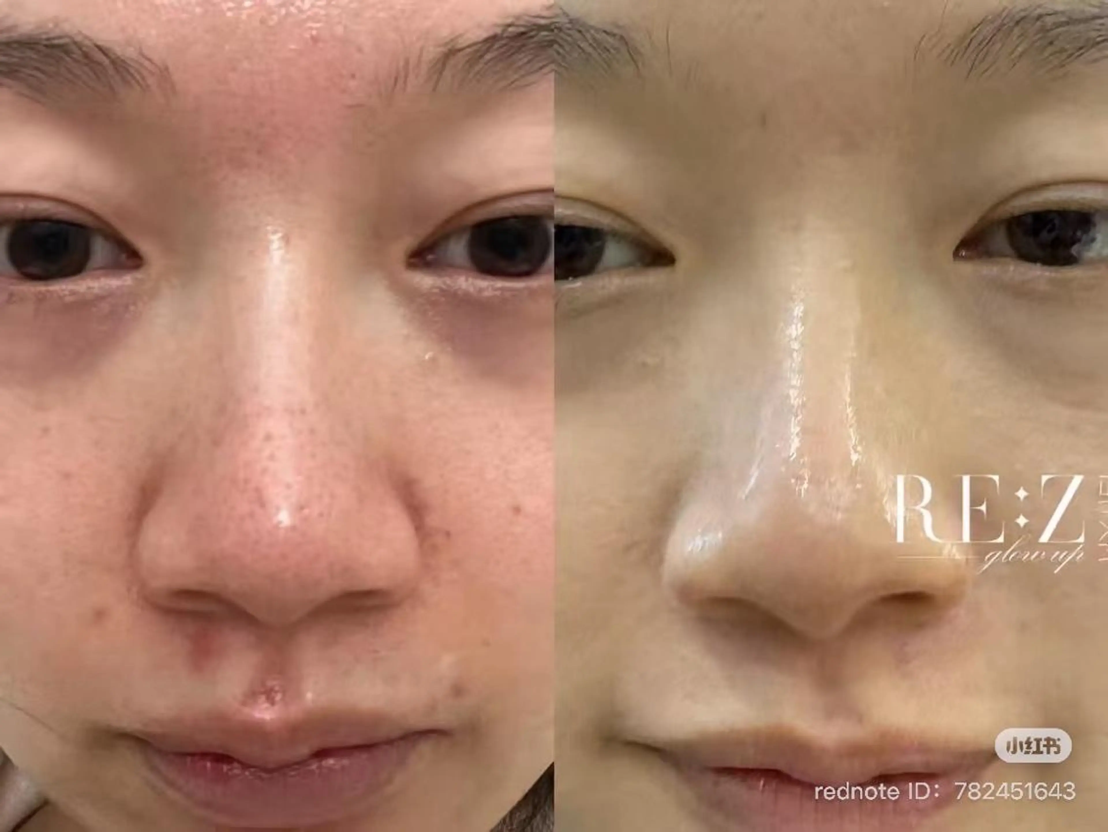 【30分で毛穴改善/促進🌿】小鼻ワックス＋韓国肌質改善＋プラセンタ美容液ケア💫の写真