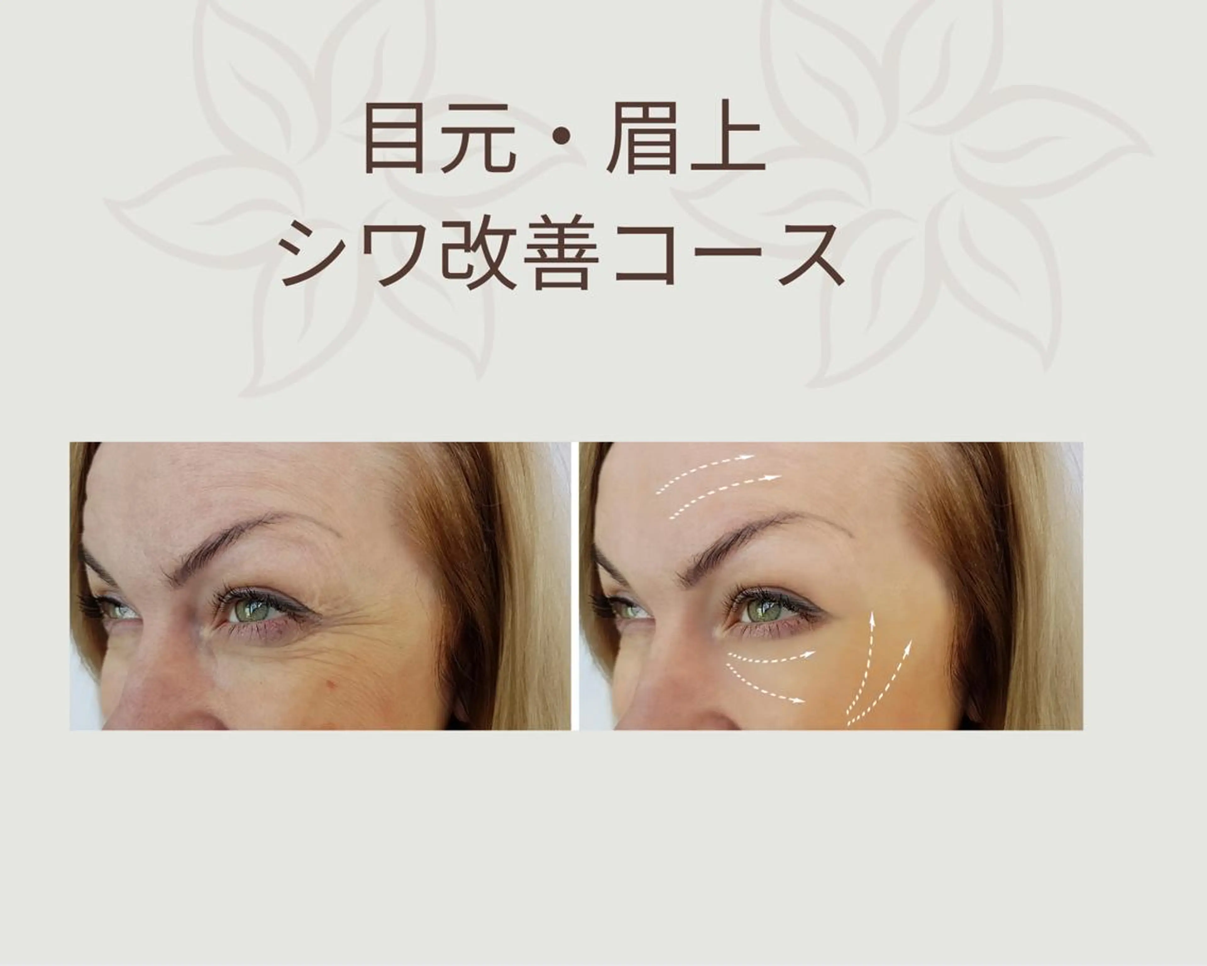 【整体フェイシャル】　目元/眉上　シワ緩和コースの写真
