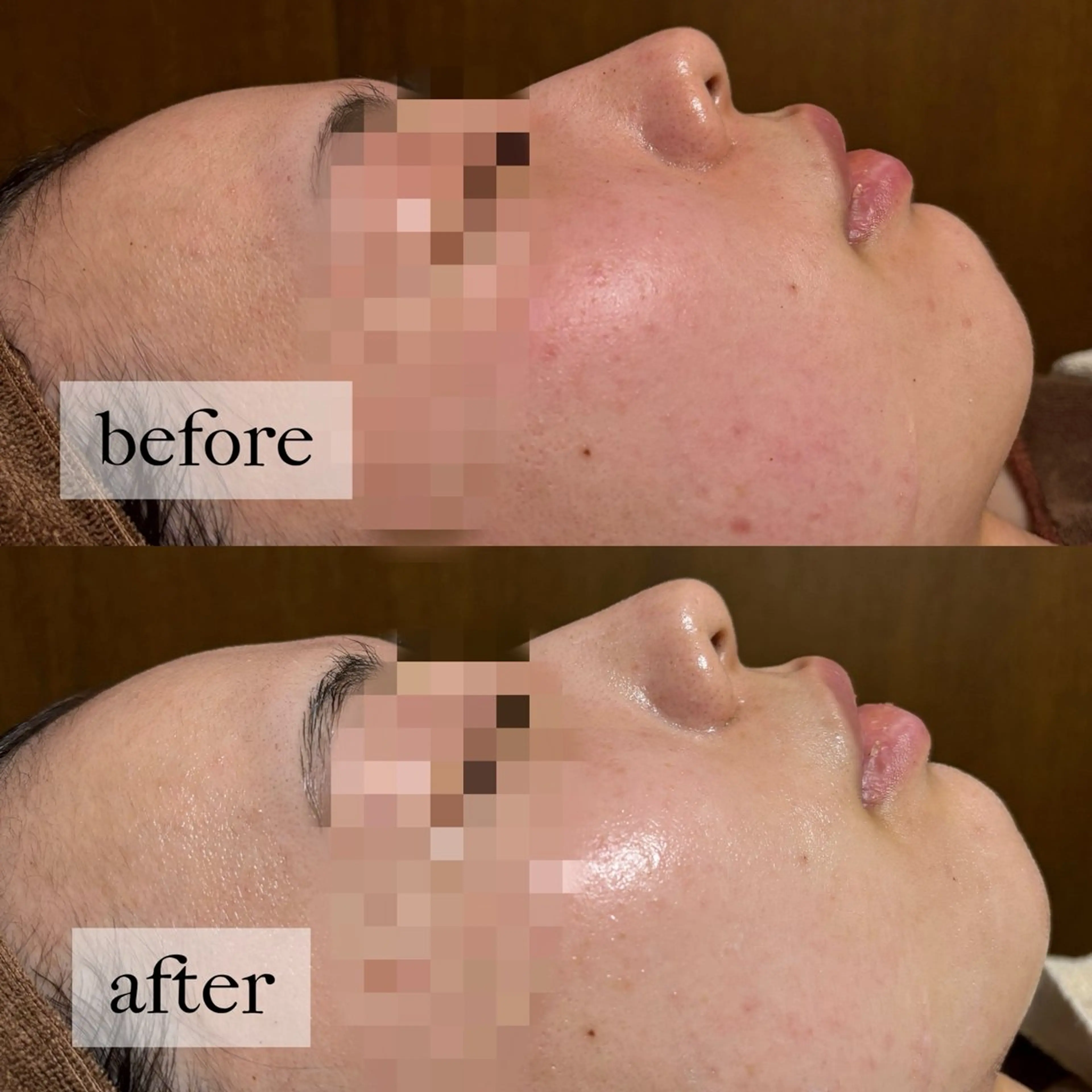 HINANO矢場町店【ヒナノ】所属・脱毛/肌改善🌿 HINANO 村田のエステ・リラクイメージ