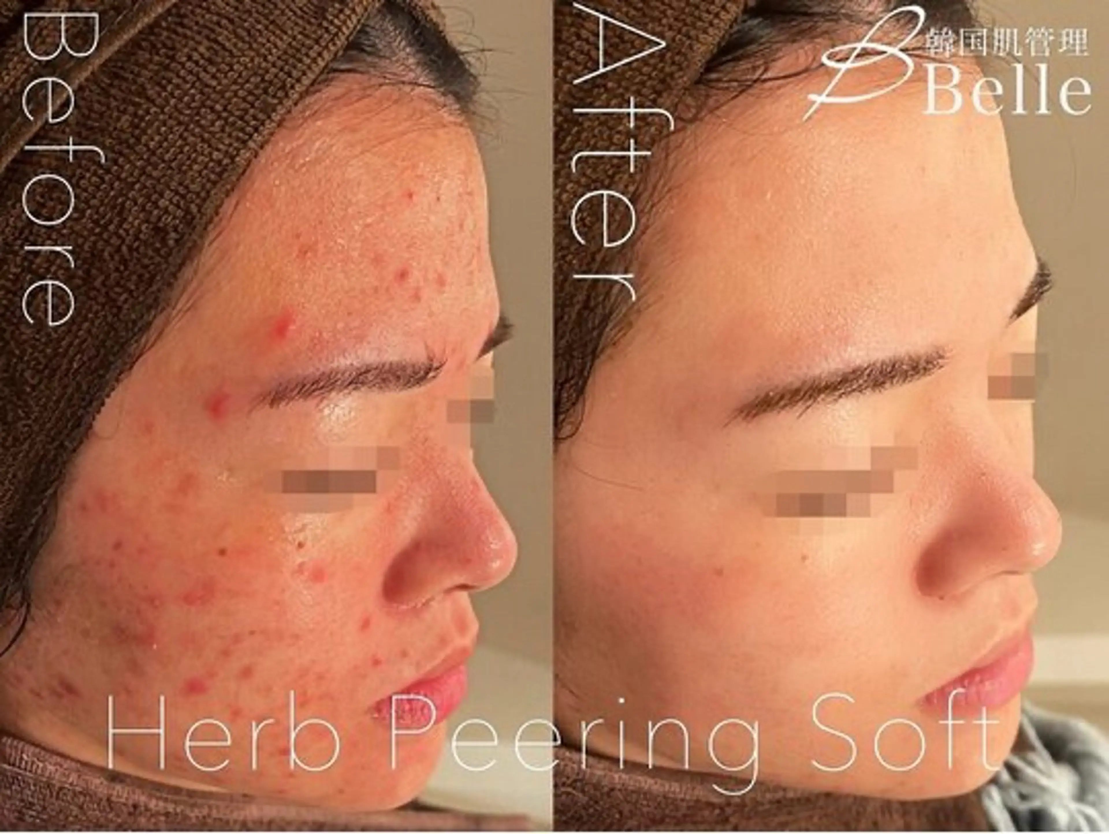 ハーブピーリング🌿 asukaのエステ・リラクイメージ