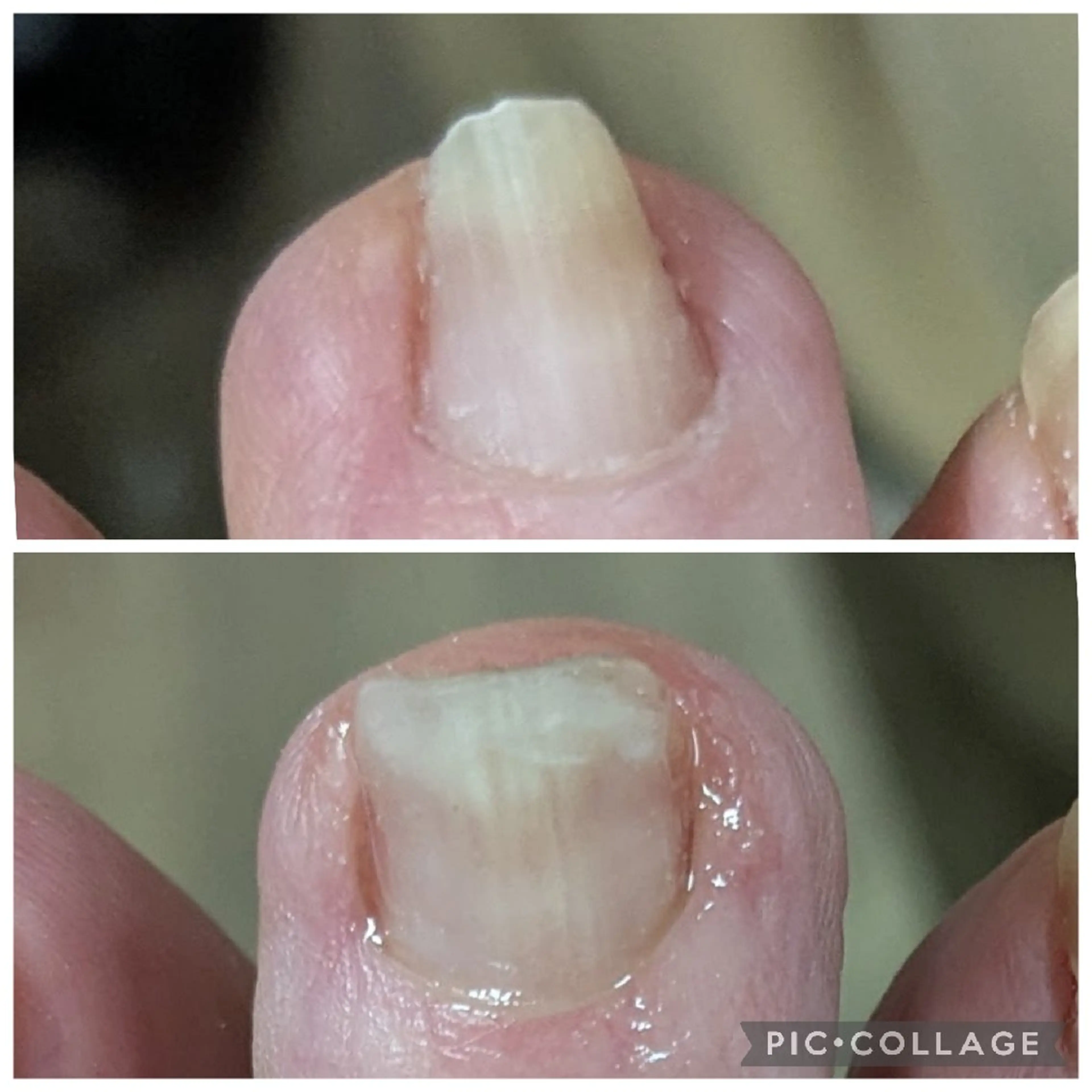 巻き爪補正(1本)の写真