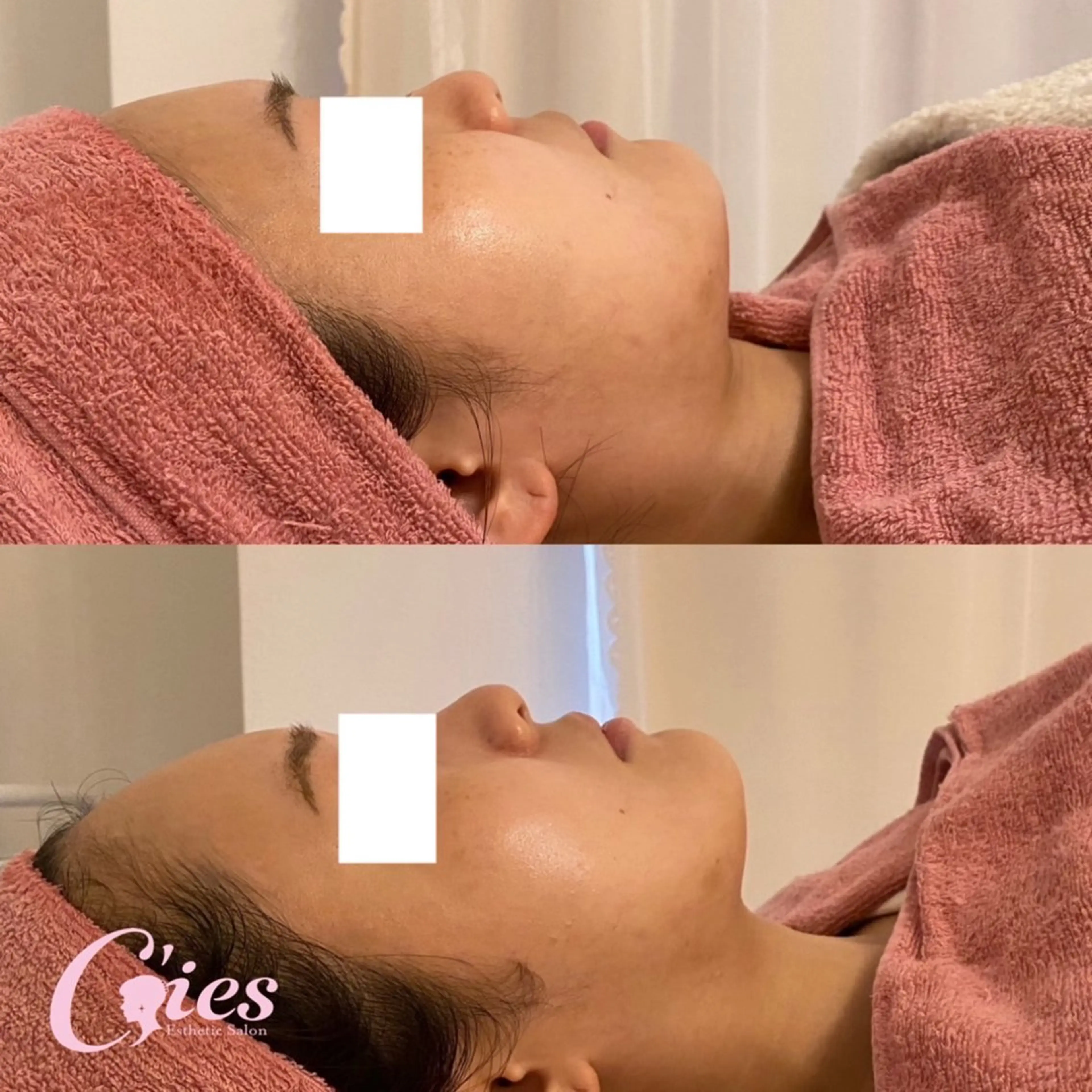 【新年度キャンペーン】　左右差改善、Vラインリフト、二重顎撃退、ほうれい線改善の写真