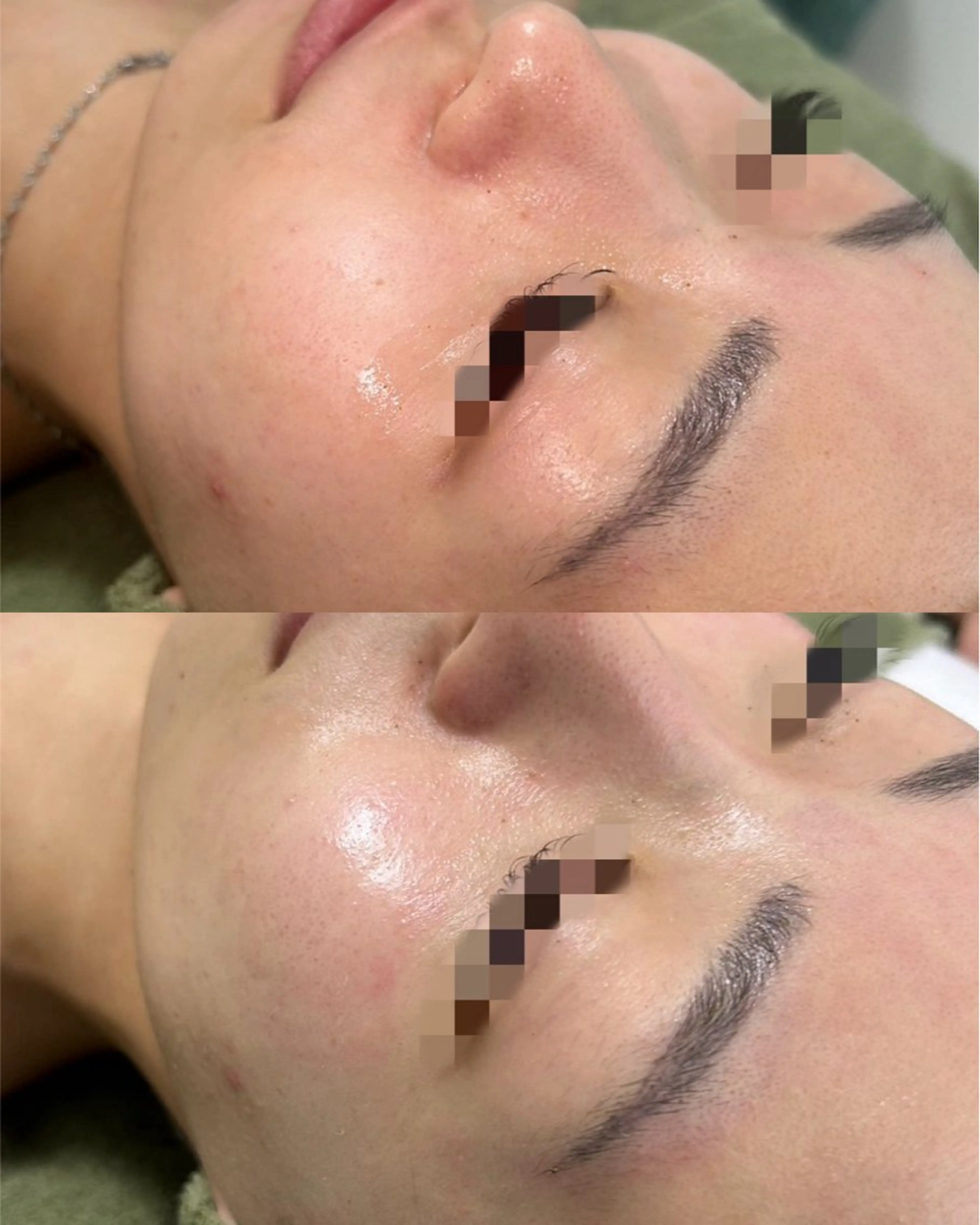 【ニキビ/毛穴改善】REVIハーブピーリング🌿美容液仕上げ✨の写真