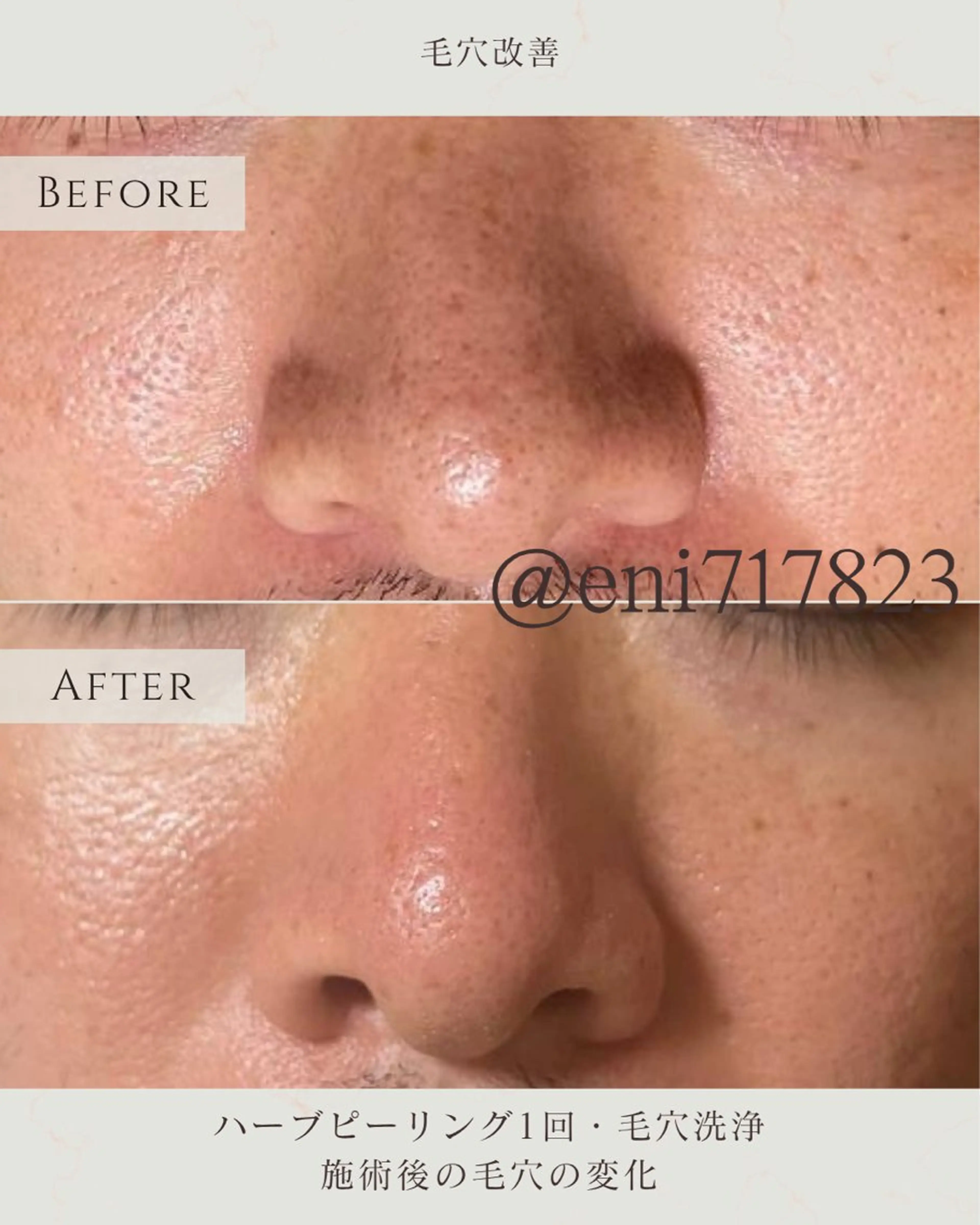 エステ シミ毛穴|眉Wax THE flowのエステ・リラクイメージ