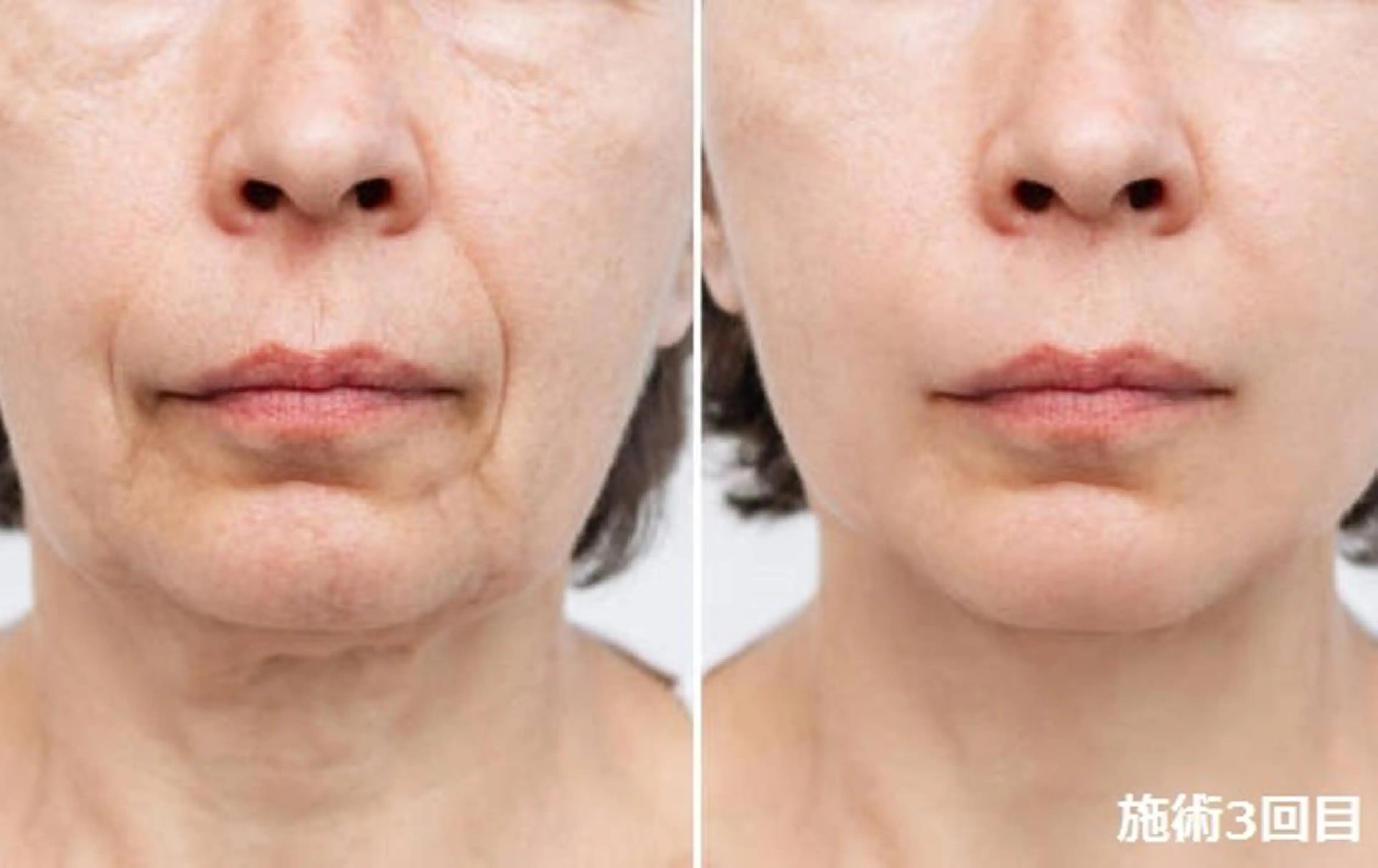 エステ 顔脱毛＆毛穴＆ニキビ 優良№1♪ヒロコ♪のエステ・リラクイメージ