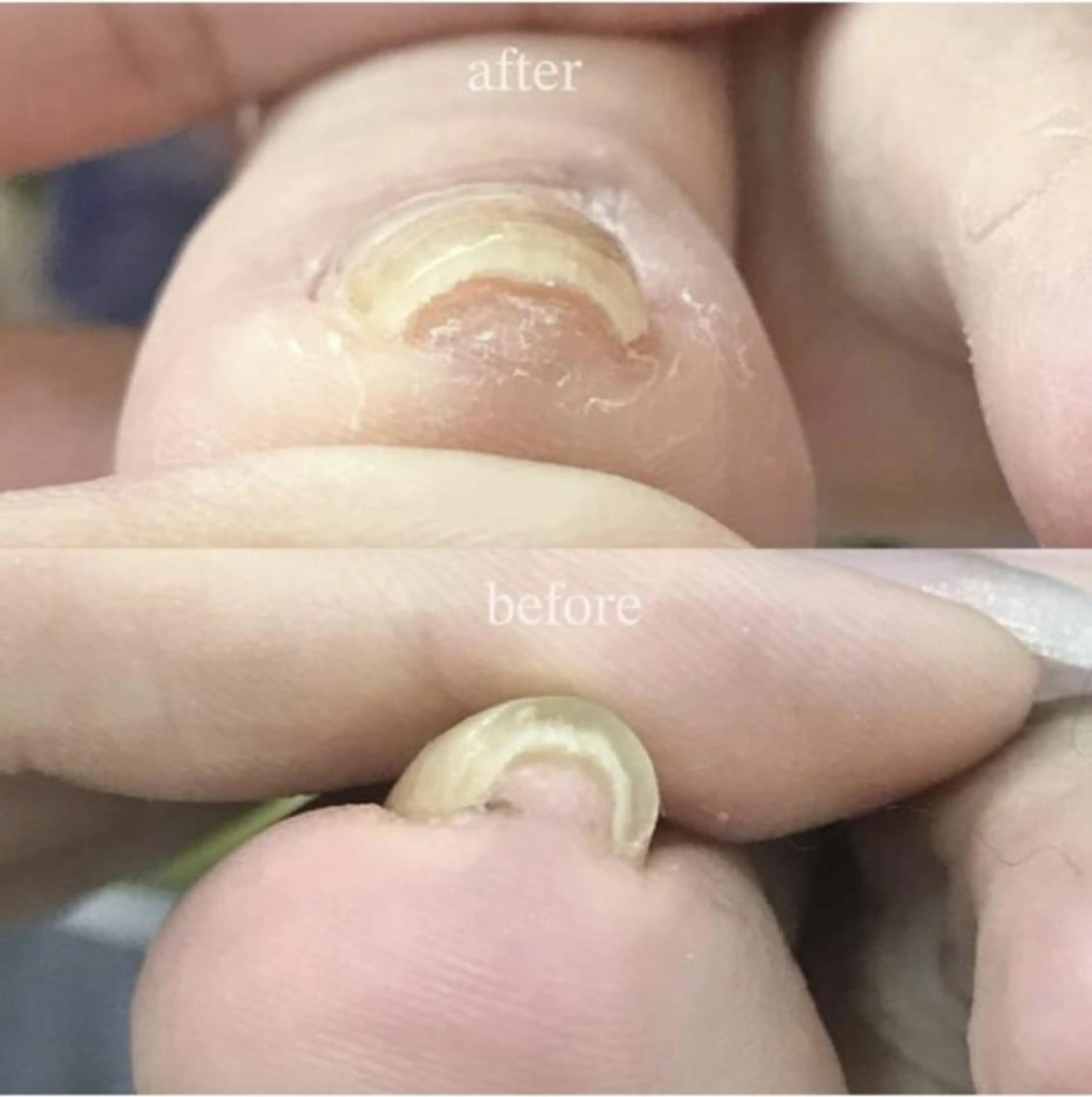 🔴フット🔴巻き爪ケアの写真