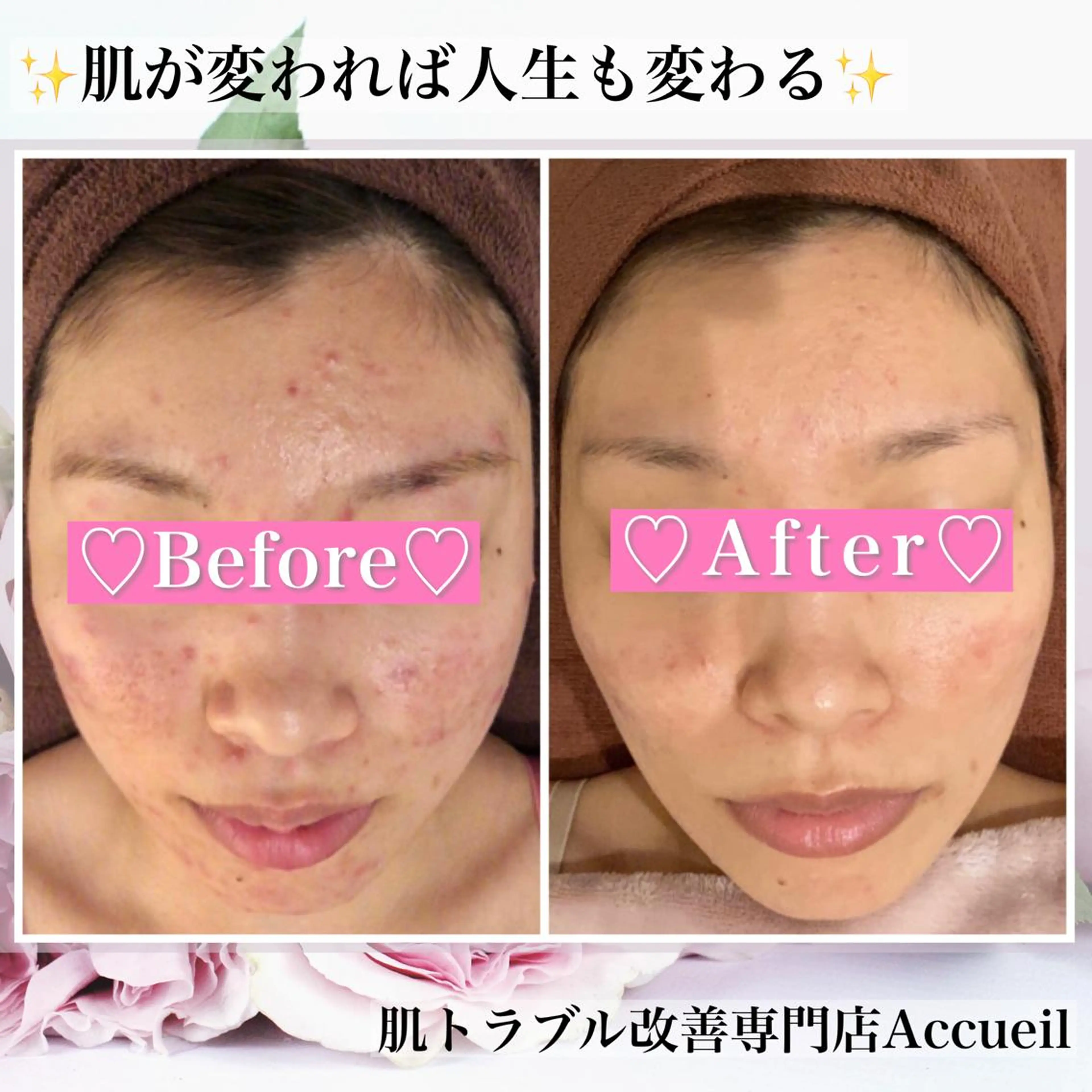 ショート カラー パーマ ヘアアレンジ メンズ キッズ ネイル マツエク・マツパ アイブロウ エステ リラク ニキビ・肌質改善専門 ♡人生が変わるサロンのエステ・リラクイメージ