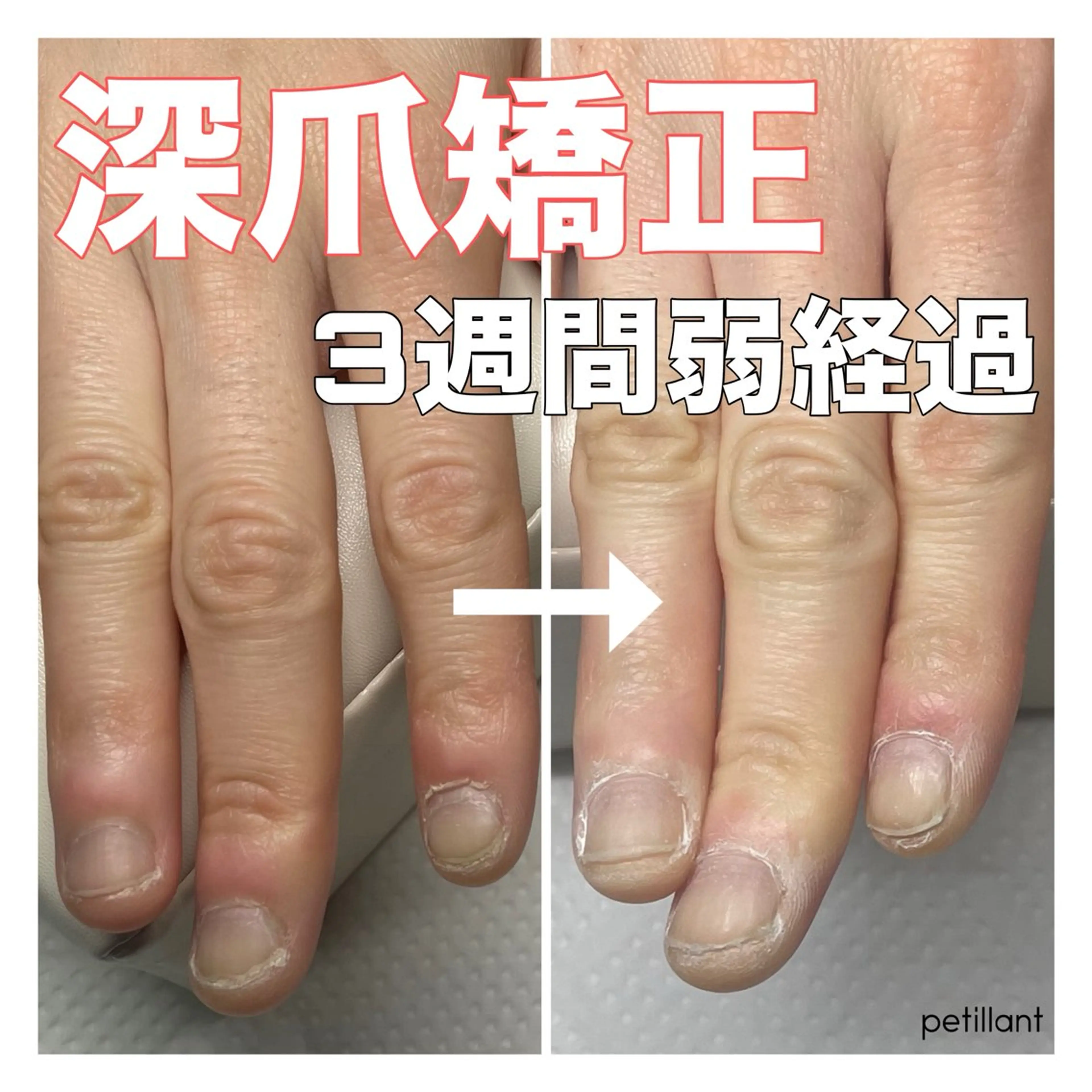 ネイル 長さ出し ピンク petillant所属・nail salon petillantのネイルデザイン