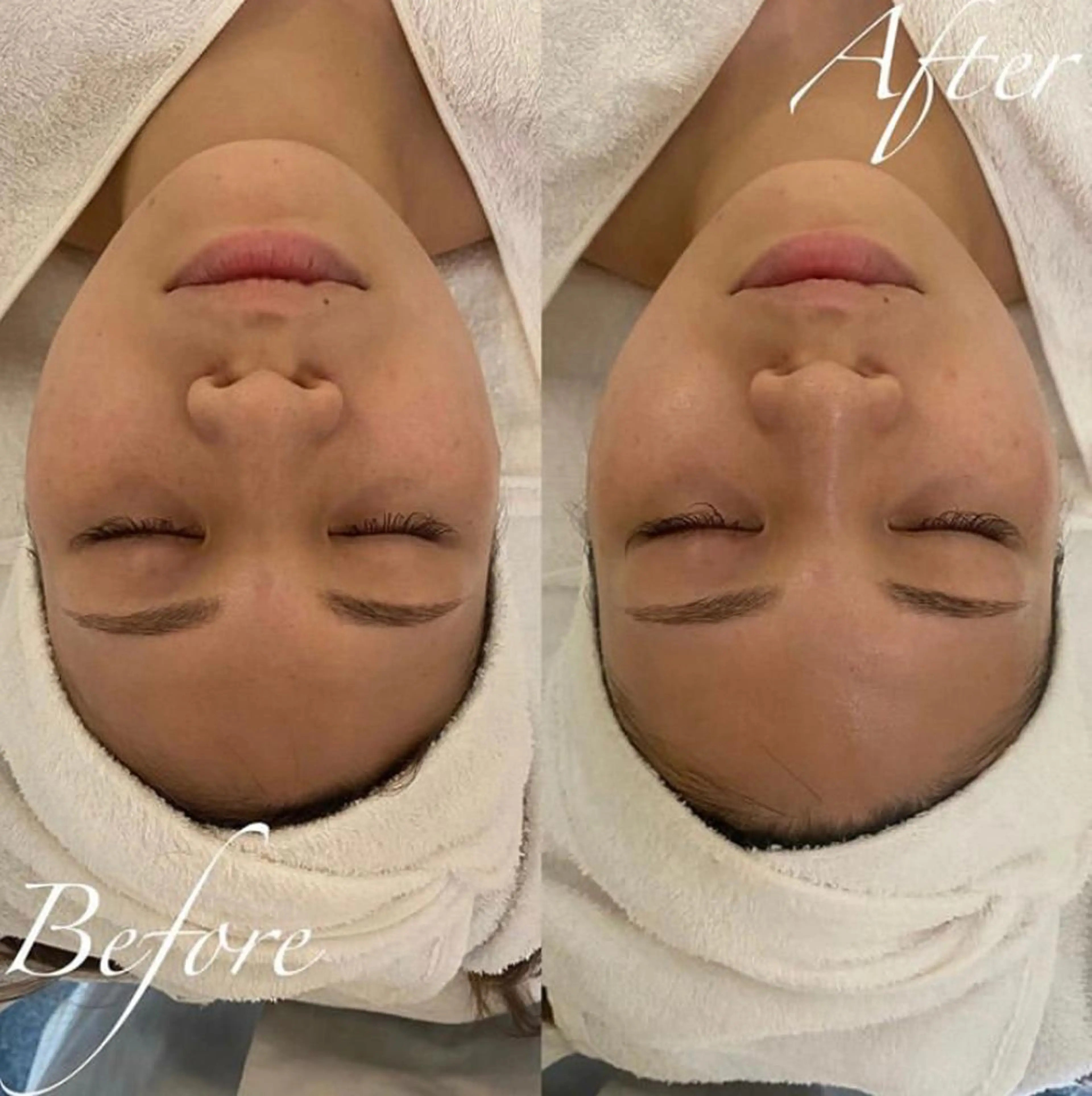 エステ リラク 毛穴/ピーリング ララピール/POLAのエステ・リラクイメージ