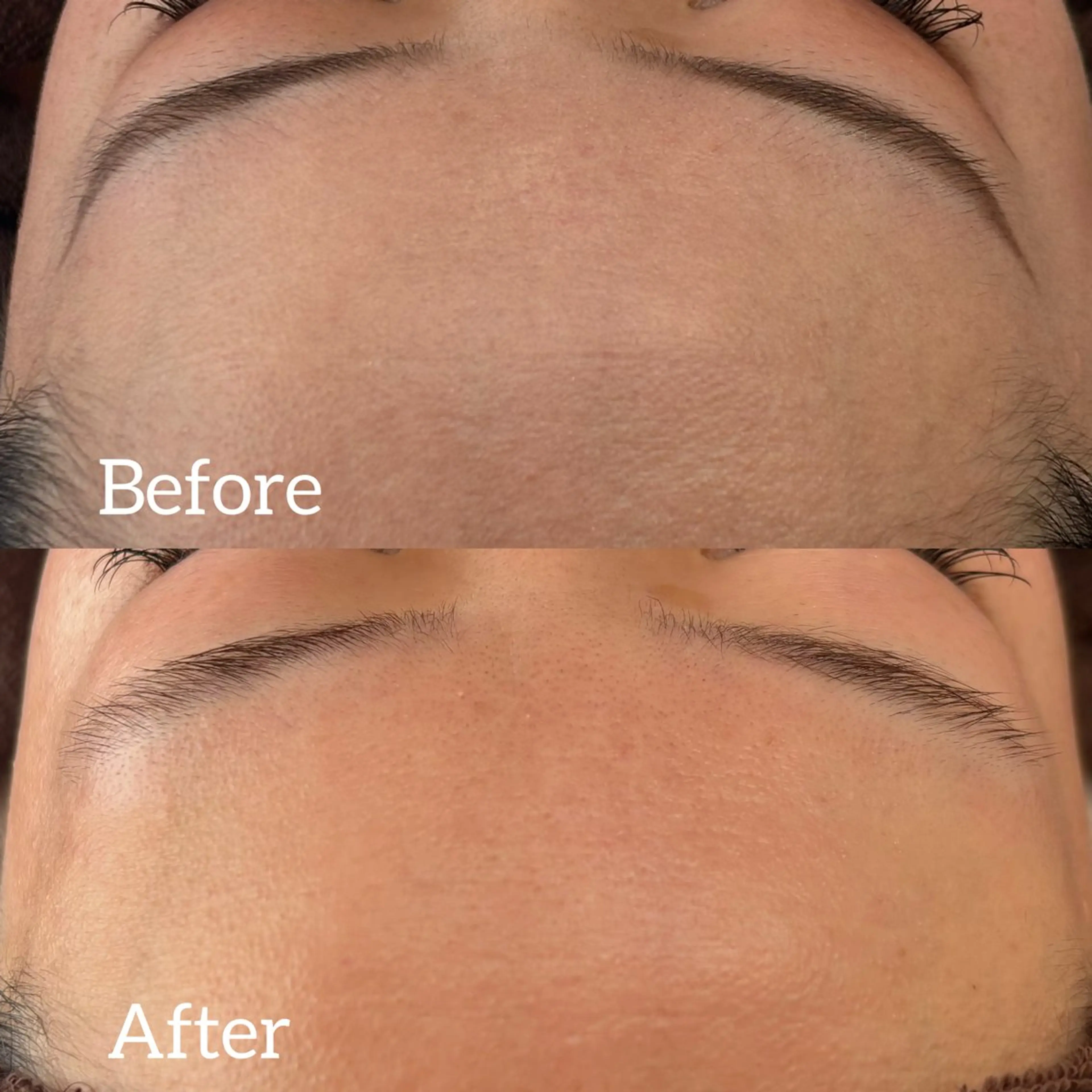 フェイスシェービング(お顔剃り)の写真