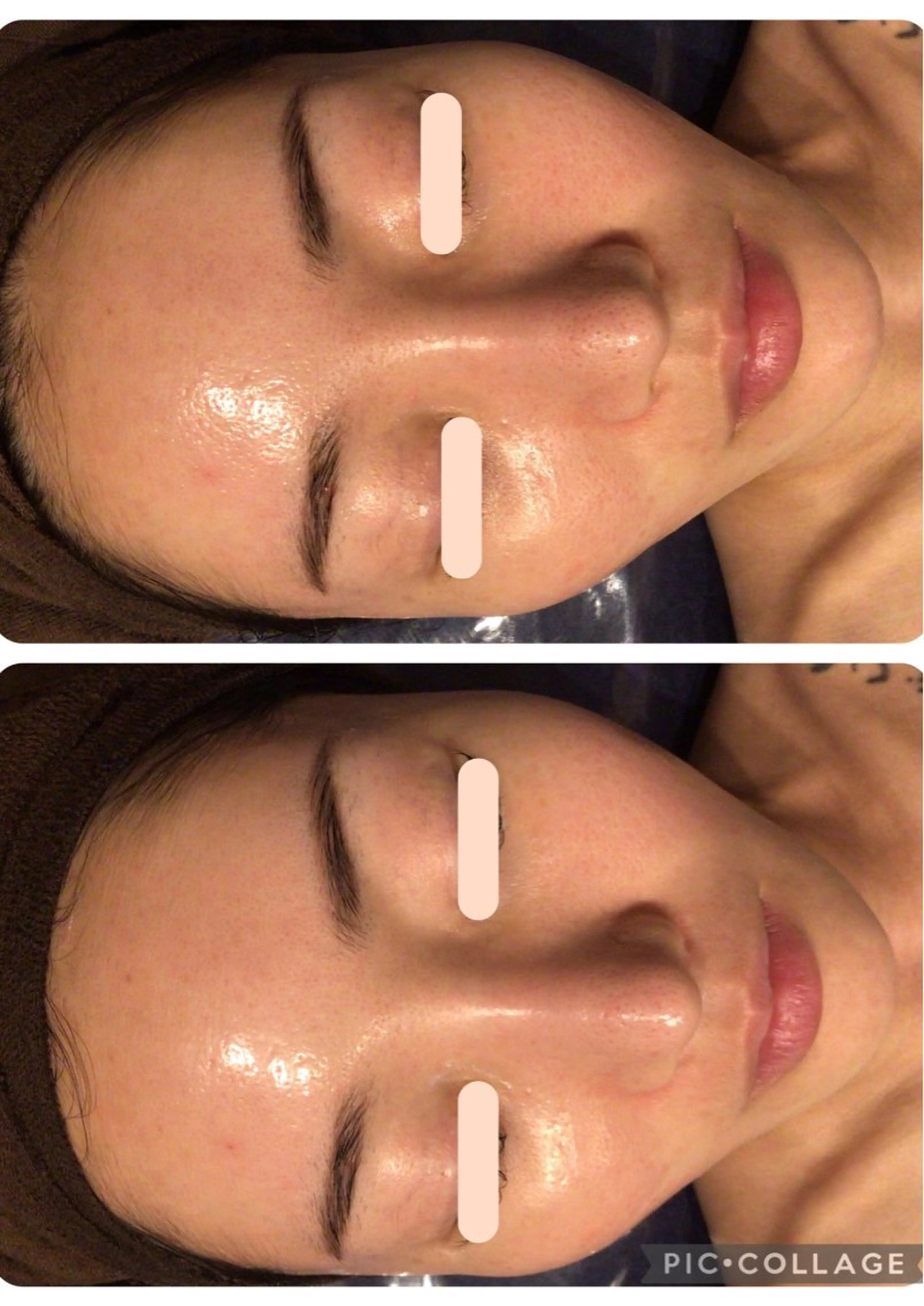 《艶肌/リフトアップ/開き毛穴》韓国肌◎ラミネーションピールの写真