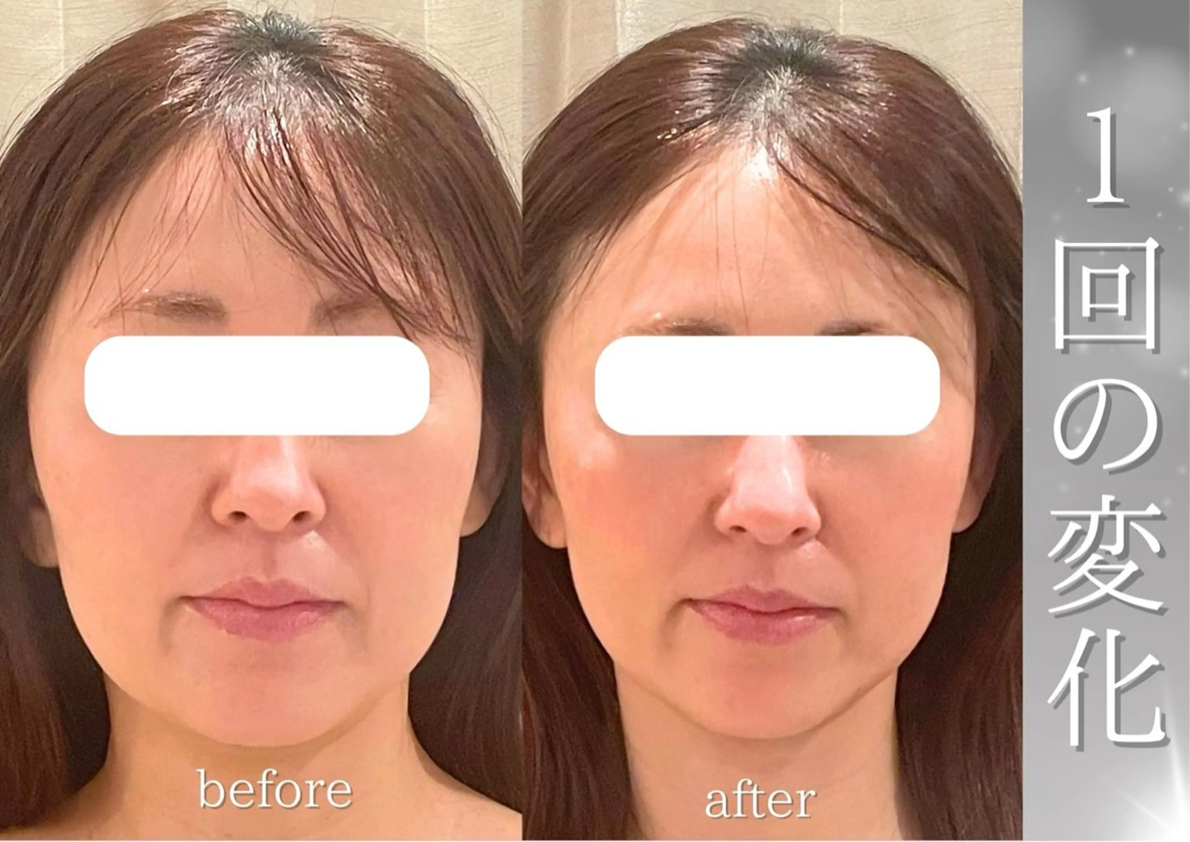 エステ 小顔/たるみ/黒ずみ除去専門サロン/SONA 大和西大寺店所属・【小顔専門看護師 サロンSONA】のエステ・リラクイメージ