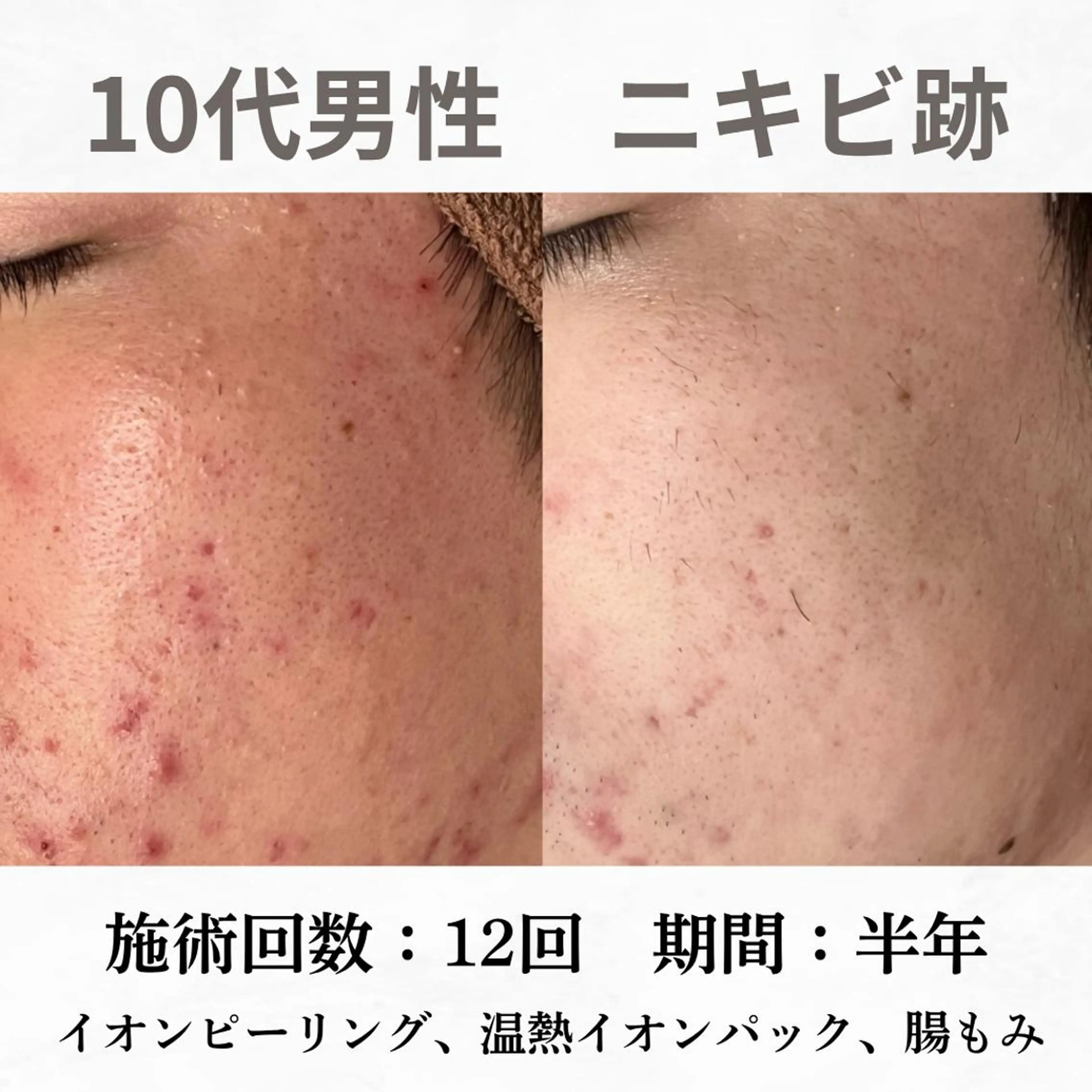 重度ニキビ専門🌷 ダウンタイムなしのエステ・リラクイメージ