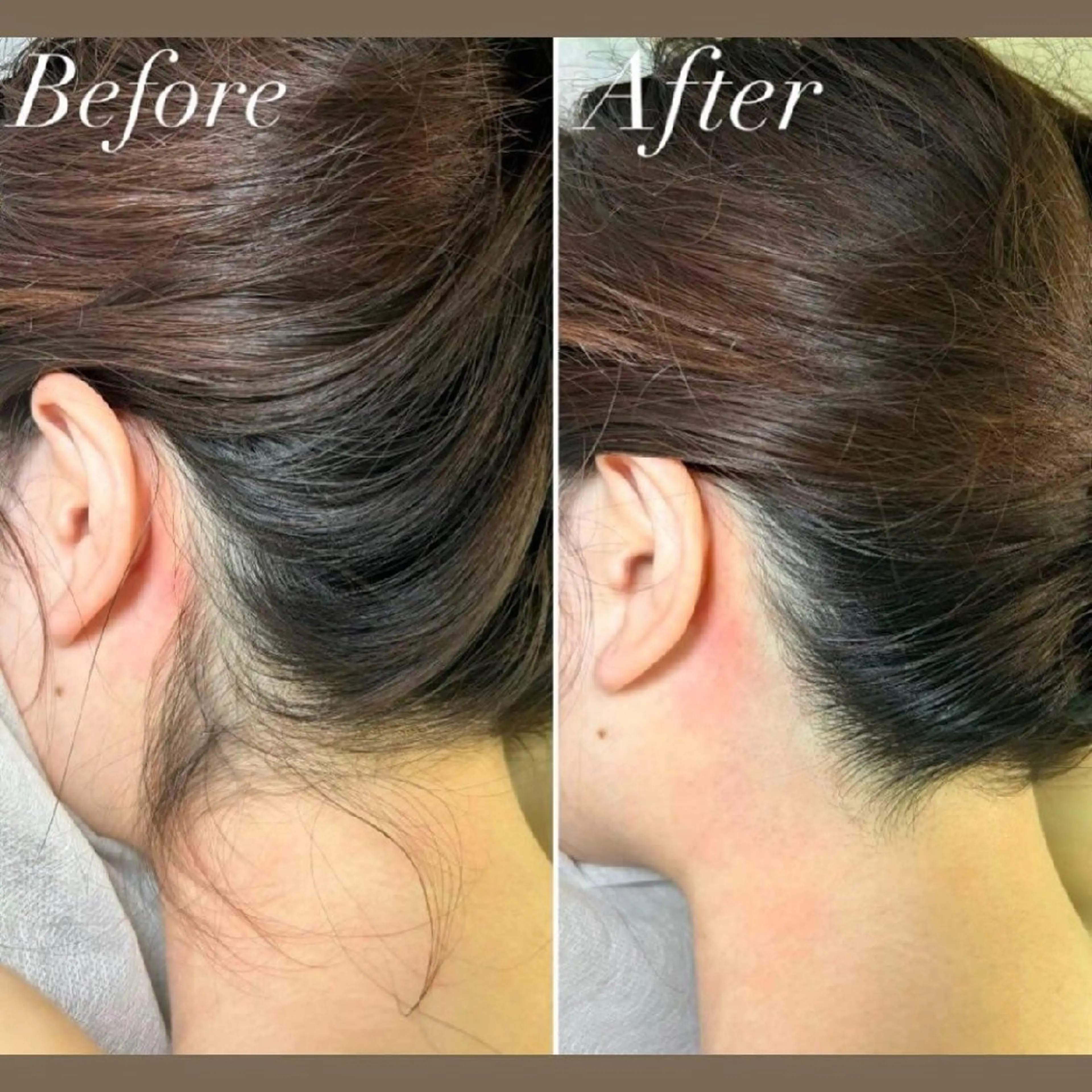 【後ろ姿に自信】本格うなじシェービング+美肌保湿✨髪を上げたくなる首筋への写真